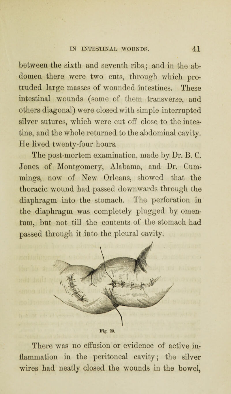 between the sixth and seventh ribs; and in the ab¬ domen there were two cuts, through which pro¬ truded large masses of wounded intestines. These intestinal wounds (some of them transverse, and others diagonal) were closed with simple interrupted silver sutures, wliich were cut off close to the intes¬ tine, and the whole returned to the abdominal cavity. He lived twenty-four hours. The post-mortem examination, made by Dr. B. C. Jones of Montgomery, Alabama-, and Dr. Cum¬ mings, now of New Orleans, showed that the thoracic wound had passed downwards through the diaphragm into the stomach. The perforation in the diaphragm was completely plugged by omen¬ tum, but not till the contents of the stomach had passed through it into the pleural cavity. There was no effusion or evidence of active in- llammation in the peritoneal cavity; the silver wires had neatly closed the wounds in the bowel,