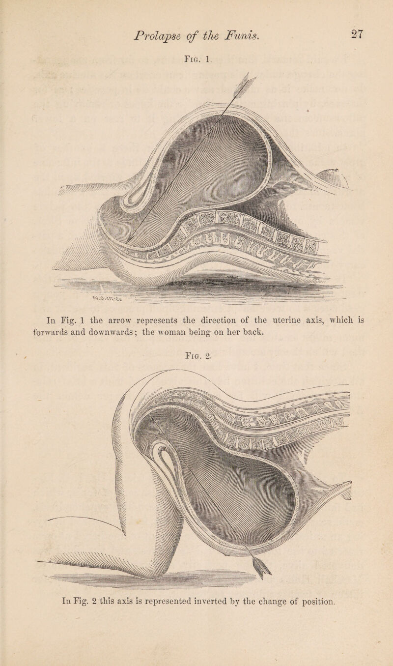 Fig. 1, In Fig. 1 the arrow represents the direction of the forwards and downwards; the woman being on her back. uterine axis, which is Fig. 2. In Fig. 2 this axis is represented inverted by the change of position