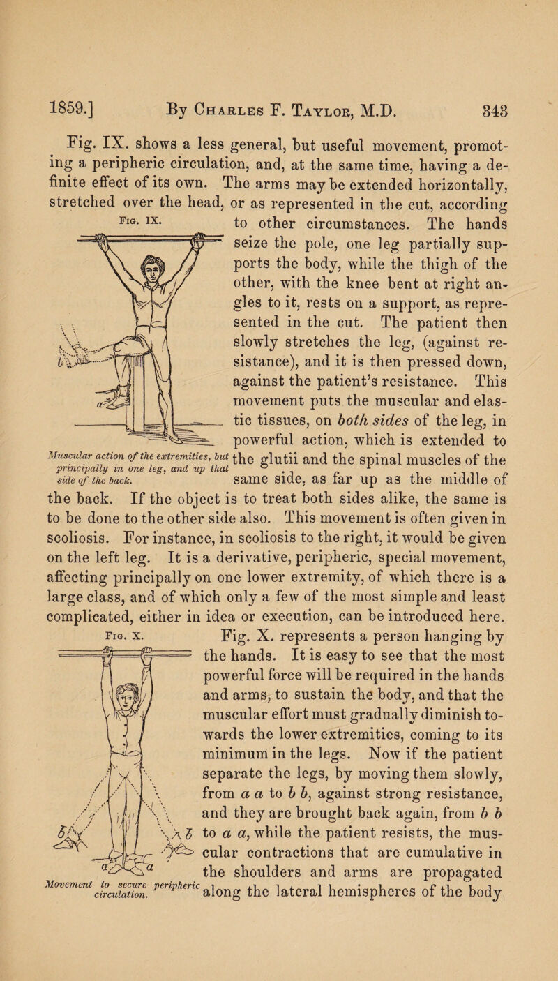 A A } 1 f V IB Fig. IX. shows a less general, but useful movement, promot- ing a peripheric circulation, and, at the same time, having a de¬ finite effect of its own. The arms may be extended horizontally, stretched over the head, or as represented in the cut, according Fig- ix- to other circumstances. The hands seize the pole, one leg partially sup¬ ports the body, while the thigh of the other, with the knee bent at right an¬ gles to it, rests on a support, as repre¬ sented in the cut. The patient then slowly stretches the leg, (against re¬ sistance), and it is then pressed down, against the patient’s resistance. This movement puts the muscular and elas- __ tic tissues, on both sides of the leg, in powerful action, which is extended to Muscular action of the extremities, but glutii and the spinal muscles of the principally in one leg, and up that ° 1 side of the back. same side, as far up as the middle of the back. If the object is to treat both sides alike, the same is to be done to the other side also. This movement is often given in scoliosis. For instance, in scoliosis to the right, it would be given on the left leg. It is a derivative, peripheric, special movement, affecting principally on one lower extremity, of which there is a large class, and of which only a few of the most simple and least complicated, either in idea or execution, can be introduced here. fig. x. Fig. X. represents a person hanging by the hands. It is easy to see that the most powerful force will be required in the hands and arms, to sustain the body, and that the muscular effort must gradually diminish to¬ wards the lower extremities, coming to its minimum in the legs. Now if the patient separate the legs, by moving them slowly, from a a to b 6, against strong resistance, and they are brought back again, from b b \ H £ to a a, while the patient resists, the mus- 7^ cular contractions that are cumulative in the shoulders and arms are propagated Movement to^ecur^ peripheric a]ong ^ ]ateral hemispheres of the body