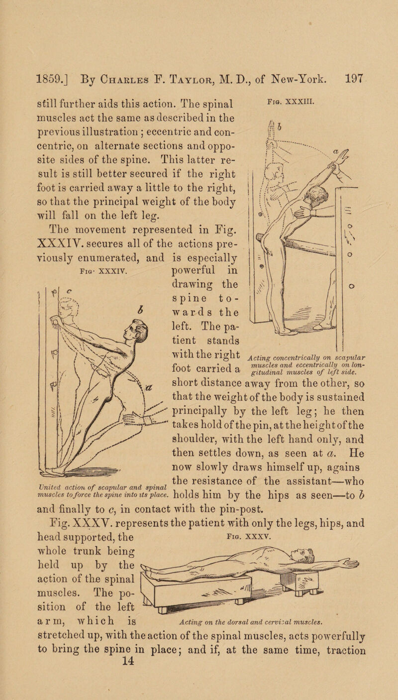 Fig. XXXIII. im Fig- XXXIV. still further aids this action. The spinal muscles act the same as described in the previous illustration ; eccentric and con¬ centric, on alternate sections and oppo¬ site sides of the spine. This latter re¬ sult is still better secured if the right foot is carried away a little to the right, so that the principal weight of the body will fall on the left leg. The movement represented in Fig. XXXIY. secures all of the actions pre¬ viously enumerated, and is especially powerful in drawing the spine to¬ wards the left. The pa¬ tient stands With the right Acting concentrically on scapular -fnnf norviarl o muscles and eccentrically onlon- iuui Cdirieu a gitudinal muscles of left side. short distance away from the other, so that the weight of the body is sustained principally by the left leg; he then 3-r takes hold of the pin, at the height of the shoulder, with the left hand only, and then settles down, as seen at a. He now slowly draws himself up, agains T7 . , . the resistance of the assistant—who United action of scapular and spinal muscles to force the spine into its place, holds him by the hipS aS Seen-to 5 and finally to <?, in contact with the pin-post. Fig. XXXV. represents the patient with only the legs, hips, and head supported, the fig. xxxv. whole trunk being held up by the action of the spinal muscles. The po¬ sition of the left arin, which IS Acting on the dorsal and cervical muscles. stretched up, with the action of the spinal muscles, acts powerfully to bring the spine in place: and if, at the same time, traction 14