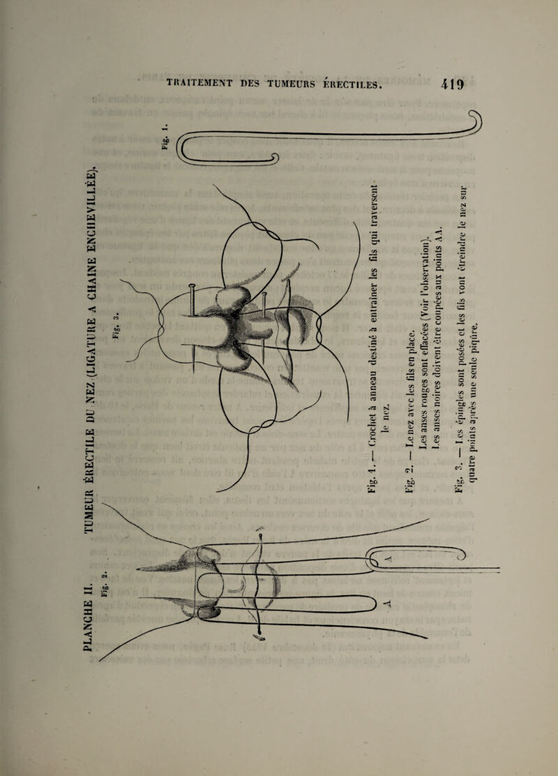 PLANCHE IL TUMEUR ÉRECTILE DU NEZ (LIGATURE A CHAINE ENCHEVILLÉE). 3 en **■ **• es *o Ch S en X MM 3 ** en 4* 'O *3 G. 3 en ej vO es € ■ ■ C- *3 CG en en en o rw en O M> —* 3 • ~ O O w o 3 >■ en en es O O N en G en O C3 C3 O en a en O en - 9 en a? 'CJ en O <3 ~ o O ? en O <n 3 Se r ~ '••V en — o g Cl fci> o s» .rf