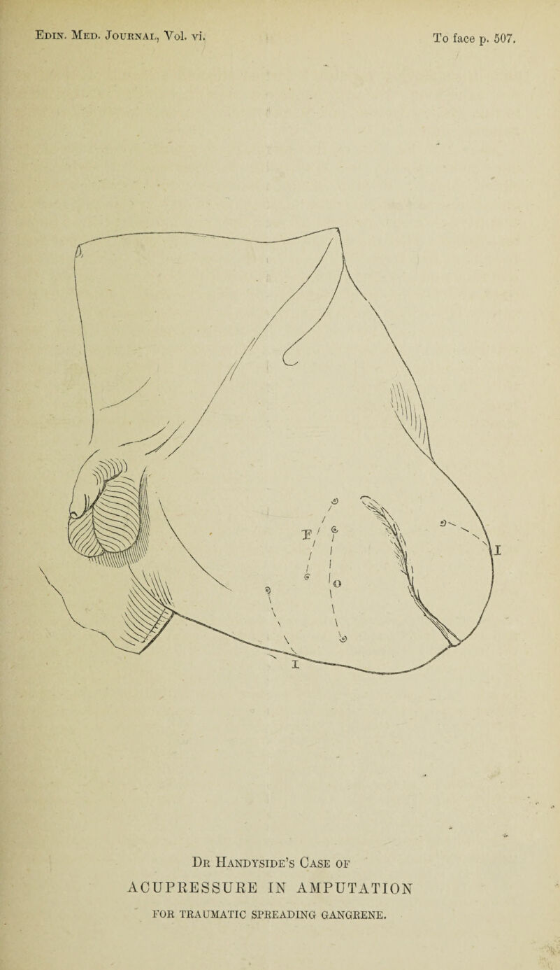 Edin. Med. Journal, Vol. yi. To face p. 507. Dr Handyside’s Case of ACUPRESSURE IN AMPUTATION FOR TRAUMATIC SPREADING GANGRENE.