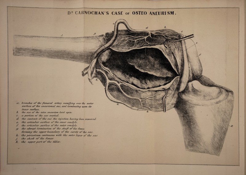 r St D!! ( ARNOCHAN’S CASE of OSTEO ANECKISM • v<'‘' v fey or. b. c. d. c. f ^■ 7l J k. & ^' t. wl. ; bj-anA^Aes o/^ the fe?fior(zt arterjr ramz/yni^ ove?’ the ouster siu^face of th^ aneurismal sac, ami ter/TuncUm^ upom its inner surface. tile saC' of tiu' osteo -a?iejirism icurt- open, a pariio7? vf the sac eicrtecL. the conte/tts of the sae^ t/ie inJeciio7t^ hen inp beeri raneved. the articulcij^ siu^/hee of the irtTiC/^ eorufyle. the artieiiiei/' sa7face of tiie outer coitd^he. the ahri7pt ter7ni7icitio7i of the shaft of thc^fe/mv, forrTtm^ the uppee^ boimdaej of the cca^it^r of the sae^. t/ie periostei7J77 coTiti/aimis wiihi the outei^ laxe7^ of the sac. thp shaft of the fer7?^7r. the upper part of ttie tihieu. ' fif rS> * '■‘■f v\^' ■ • ■4' ’1 r. ■#v mmS y^>^'-yV®\xW a®'-:. v'yWl