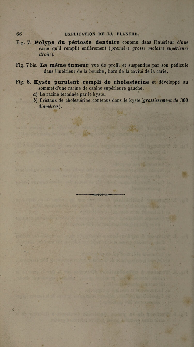 Fig. 7. Polype du périoste dentaire contenu dans l’intérieur d’une carie qu’il remplit entièrement ( première grosse molaire supérieure droite). Fig. 7 bis. La même tumeur vue de profil et suspendue par son pédicule dans l'intérieur de la bouche, hors de la cavité de la carie. Fig. 8. Kyste purulent rempli de cholestérine et développé au sommet d’une racine de canine supérieure gauche. a) La racine terminée par le kyste. b) Cristaux de cholestérine contenus dans le kyste (grossissement de 300 diamètres). «««a