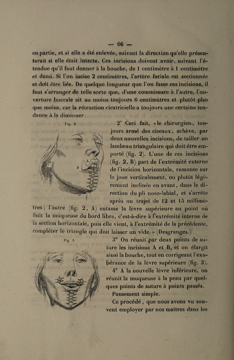 en partie, et si elle a été enlevée, suivant la direction qu’elle présen¬ terait si elle était intacte. Ces incisions doivent avoir, suivant l’é¬ tendue qu’il faut donner à la bouche, de 1 centimètre à 1 centimètre et demi. Si l’on incise 2 centimètres, l’artère faciale est sectionnée et doit être liée. De quelque longueur que l’on fasse ces incisions, il faut s’arranger de telle sorte que, d’une commissure à l’autre, l’ou¬ verture buccale ait au moins toujours 6 centimètres et plutôt plus que moins, car la rétraction cicatricielle a toujours une certaine ten¬ dance à la diminuer. jours armé des ciseaux, achève, par deux nouvelles incisions, de tailler un lambeau triangulaire qui doit être em¬ porté (fig. 2). L’une de ces incisions (fig. 2, B) part de l’extrémité externe de l’incision horizontale, remonte sur la joue verticalement, ou plutôt légè¬ rement inclinée en avant, dans la di¬ rection du pli noso-labial, et s’arrête '' \ après un trajet de 12 et 15 millimè¬ tres; 1 autre (fig. 2, A) entame la lèvre supérieure au point où finit la muqueuse du bord libre, c’est-à-dire à l’extrémité interne de îa section horizontale, puis elle vient, à l’extrémité de la précédente, compléter le triangle qui doit laisser un vide. » (Desgranges.) 3° On réunit par deux points de su¬ ture les incisions A et B, et on élargit ainsi la bouche, tout en corrigeant l’exu¬ bérance de la lèvre supérieure (fig. 3). 4° A la nouvelle lèvre inférieure, on réunit la muqueuse à la peau par quel¬ ques points de suture à points passés. Pansement simple. Ce procédé , que nous avons vu sou¬ vent employer par nos maîtres dans les ^ k \ Fig 3. V