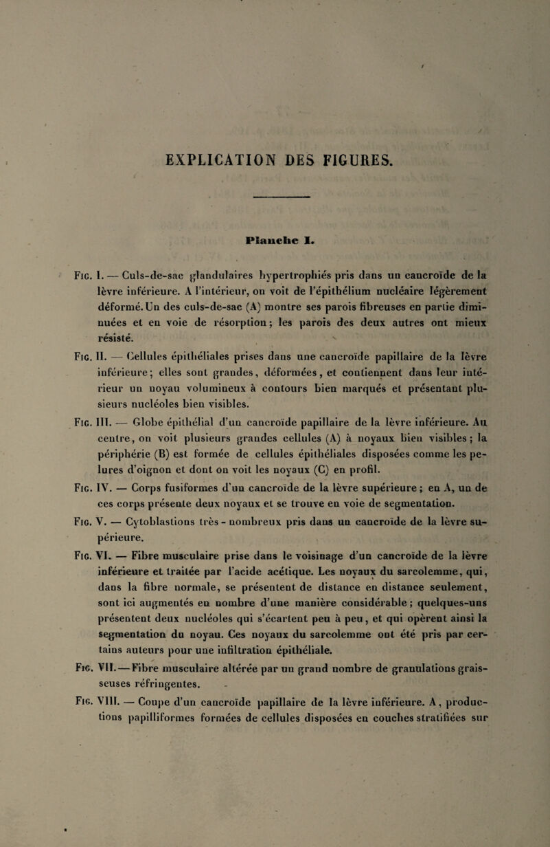 Planche I. Fig. I. — Culs-de-sac glandulaires hypertrophiés pris dans un cancroïde delà lèvre inférieure. A l’intérieur, on voit de l’épithélium nucléaire légèrement déformé. Un des culs-de-sac (A) montre ses parois fibreuses en partie dimi¬ nuées et en voie de résorption ; les parois des deux autres ont mieux résisté. Fig. II. — Cellules épithéliales prises dans une cancroïde papillaire de la lèvre inférieure; elles sont grandes, déformées, et contiennent dans leur inté¬ rieur un noyau volumineux à contours bien marqués et présentant plu¬ sieurs nucléoles bien visibles. Fig. III. — Globe épithélial d’un cancroïde papillaire de la lèvre inférieure. Au centre, on voit plusieurs grandes cellules (A) à noyaux bien visibles; la périphérie (B) est formée de cellules épithéliales disposées comme les pe¬ lures d’oignon et dont on voit les noyaux (C) en profil. Fig. IV. — Corps fusiformes d'un cancroïde de la lèvre supérieure ; en A, un de ces corps présente deux noyaux et se trouve en voie de segmentation. Fig. V. — Cytoblastions très - nombreux pris dans un cancroïde de la lèvre su¬ périeure. Fig. VI. — Fibre musculaire prise dans le voisinage d’un cancroïde de la lèvre inférieure et traitée par l’acide acétique. Les noyaux du sarcolemme, qui, dans la fibre normale, se présentent de distance en distance seulement, sont ici augmentés en nombre d’une manière considérable ; quelques-uns présentent deux nucléoles qui s’écartent peu à peu, et qui opèrent ainsi la segmentation du noyau. Ces noyaux du sarcolemme ont été pris par cer¬ tains auteurs pour une infiltration épithéliale. Fig. VII. — Fibre musculaire altérée par un grand nombre de granulations grais¬ seuses réfringentes. Fig. VI1Ï. — Coupe d’un cancroïde papillaire de la lèvre inférieure. A, produc¬ tions papilliformes formées de cellules disposées en couches stratifiées sur