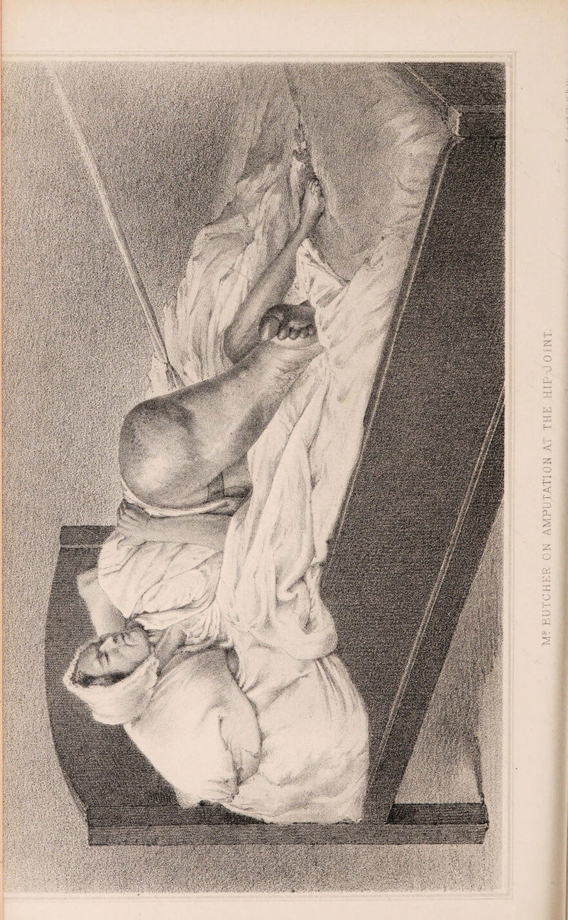 ; n ^aamss IPS Sfeife W&mm np| ®p@l i™ iiias Il»3iff l gSpilR dlfe M'Aw-fcV* •#$Mi iSpS w: mis mim W^00^ m • 2 BUTCHER ON AMPUTATION AT THE HIP-JOINT