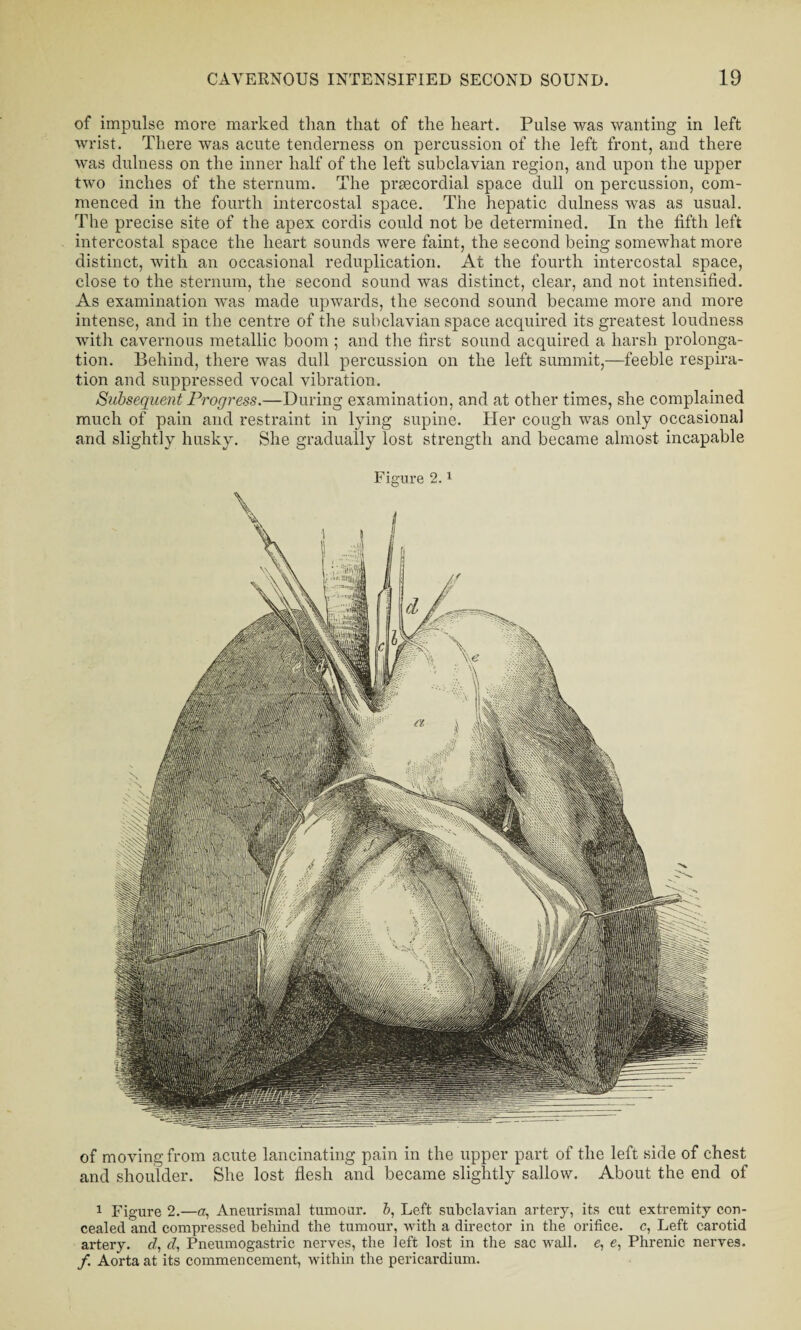 of impulse more marked than that of the heart. Pulse was wanting in left wrist. There was acute tenderness on percussion of the left front, and there was dulness on the inner half of the left subclavian region, and upon the upper two inches of the sternum. The prsecordial space dull on percussion, com¬ menced in the fourth intercostal space. The hepatic dulness was as usual. The precise site of the apex cordis could not be determined. In the fifth left intercostal space the heart sounds were faint, the second being somewhat more distinct, with an occasional reduplication. At the fourth intercostal space, close to the sternum, the second sound was distinct, clear, and not intensified. As examination was made upwards, the second sound became more and more intense, and in the centre of the subclavian space acquired its greatest loudness with cavernous metallic boom ; and the first sound acquired a harsh prolonga¬ tion. Behind, there was dull percussion on the left summit,—feeble respira¬ tion and suppressed vocal vibration. Subsequent Progress.—During examination, and at other times, she complained much of pain and restraint in lying supine. Her cough was only occasional and slightly husky. She gradually lost strength and became almost incapable Figure 2.1 of moving from acute lancinating pain in the upper part of the left side of chest and shoulder. She lost flesh and became slightly sallow. About the end of 1 Figure 2.—a, Aneurismal tumour, b, Left subclavian artery, its cut extremity con¬ cealed and compressed behind the tumour, with a director in the orifice, c, Left carotid artery, d, d, Pneumogastric nerves, the left lost in the sac wall, e, e, Phrenic nerves. /. Aorta at its commencement, within the pericardium.