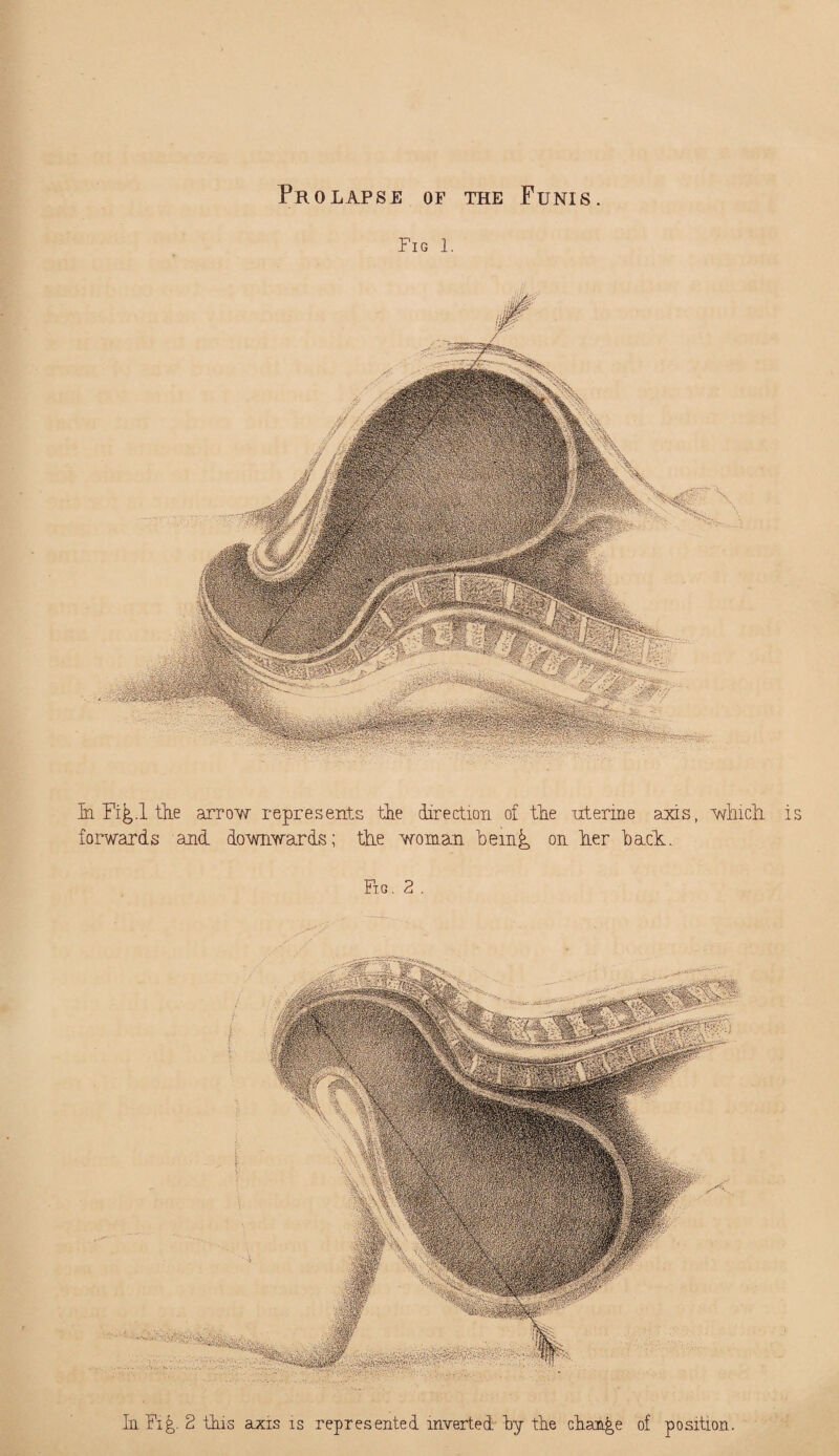 Prolapse of the Funis Fig I. hi Fi^.l the arrow represents the direction of the uterine axis, which forwards and downwards; the woman hem^ on her hack. Fig. 2 . In Fi£,- 2 this axis is represented inverted hy the change of position. Mima 0x?0x;?y;] is