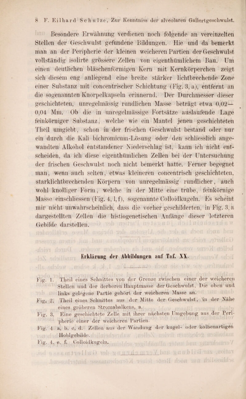 Besondere Erwähnung verdienen noch folgende an vereinzelten Stellen der Geschwulst gefundene Bildungen, tlie und da bemerkt man an der Peripherie der kleinen weicheren Partien der Geschwulst vollständig isolirte grössere Zellen von eigenthümlichem Bau. Um einen deutlichen bläschenförmigen Kern mit Kernkörperchen zeigt sich diesem eng anliegend eine breite stärker lichtbrechende Zone einer Substanz mit concentrischer Schichtung (Fig. 3, a), entfernt an die sogenannten Knorpelkapseln erinnernd. Der Durchmesser dieser geschichteten, unregelmässig rundlichen Masse beträgt etwa 0,02— 0,04 Mm. Ob die in unregelmässige Fortsätze auslaufende Lage feinkörniger Substanz, welche wie ein Mantel jenen geschichteten Theil umgiebt, schon in der frischen Geschwulst bestand oder nur ein durch die Kali bichromicum-Lösung oder den schliesslich ange¬ wandten Alkohol entstandener Niederschlag ist, kann ich nicht ent¬ scheiden, da ich diese eigenthümlichen Zellen bei der Untersuchung der frischen Geschwulst noch nicht bemerkt hatte. Ferner begegnet man, wenn auch selten, etwas kleineren concentrisch geschichteten, starklichtbrechenden Körpern von unregelmässig rundlicher, auch wohl knolliger Form, welche in der Mitte eine trübe, feinkörnige Masse einschliessen (Fig. 4,1, f), sogenannte Colloidkugeln. Es scheint mir nicht unwahrscheinlich, dass die vorher geschilderten, in Füg. 3, a dargestellten Zellen die histiogenetischen Anfänge dieser letzteren Gebilde darstellen. Erklärung der Abbildungen auf Taf. W. Fig. 1. Theil eines Schnittes von der Grenze zwischen einer der weicheren Stellen und der derberen Hauptmasse der Geschwulst. Hie oben und links gelegene Partie gehört der weicheren Masse an. Fiü-, 2 Theil eines Schnittes aus der Mitte der Gescliwulst, in der Nähe eines gröberen Stromabalkens, a. Fig. 3. Eine geschichtete Zelle mit ihrer nächsten Umgebung ans der Peri¬ pherie einer der weicheren Partien. Fig. 4 a, b, c, d. Zellen aus der Wandung der kngel- oder kolbenartigen Hohlgebilde. Fig. 4. e, f. Colloidkugeln.