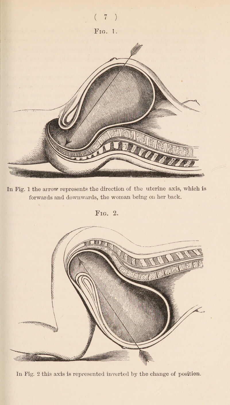 Fig. 1. In Fig. 1 the arrow represents the direction of the uterine axis, which is forwards and downwards, the woman being on her hack. Fig. 2. In Fig. 2 this axis is represented inverted by the change of position.