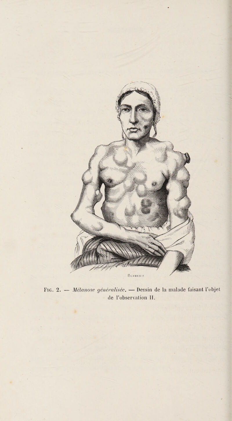 Fig. 2. — Mélanose généralisée. — Dessin de la malade faisant l’objet de l’observation II.