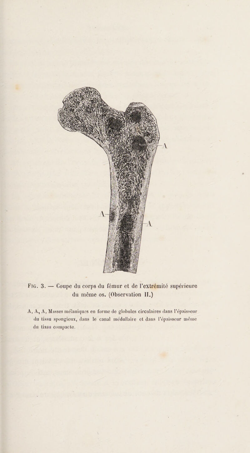 4 Fig. 3. — Coupe du corps du fémur et de l’extrémité supérieure du même os. (Observation II.) A, A, A, Masses mélaniques en forme de globules circulaires dans l’épaisseur du tissu spongieux, dans le canal médullaire et dans l’épaisseur môme du tissu compacte.