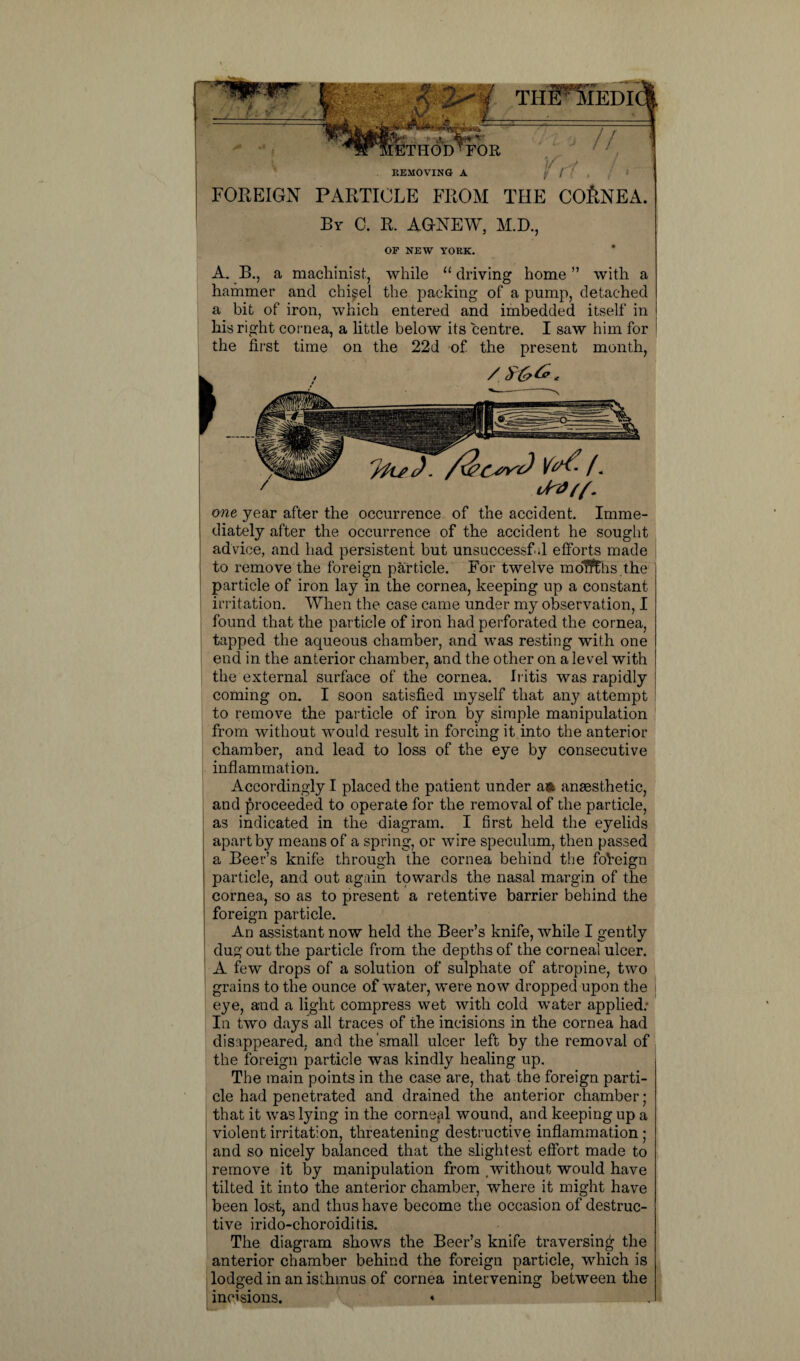 REMOVING A FOREIGN PARTICLE FROM THE COftNEA. Br C. R. AGNEW, M.D., OF NEW YORK. A. B., a machinist, while “ driving home ” with a hammer and chisel the packing of a pump, detached a bit of iron, which entered and imbedded itself in his right cornea, a little below its centre. I saw him for the first time on the 22d of the present month, one year after the occurrence of the accident. Imme¬ diately after the occurrence of the accident he sought advice, and had persistent but unsuccessful efforts made to remove the foreign particle. For twelve molfths the particle of iron lay in the cornea, keeping up a constant irritation. When the case came under my observation, I found that the particle of iron had perforated the cornea, tapped the aqueous chamber, and was resting with one end in the anterior chamber, and the other on a level with the external surface of the cornea. Iritis was rapidly coming on. I soon satisfied myself that any attempt to remove the particle of iron by simple manipulation from without would result in forcing it into the anterior chamber, and lead to loss of the eye by consecutive inflammation. Accordingly I placed the patient under aft anaesthetic, and proceeded to operate for the removal of the particle, as indicated in the diagram. I first held the eyelids apart by means of a spring, or wire speculum, then passed a Beer’s knife through the cornea behind the foVeign particle, and out again towards the nasal margin of the cornea, so as to present a retentive barrier behind the foreign particle. An assistant now held the Beer’s knife, while I gently dug out the particle from the depths of the corneal ulcer. A few drops of a solution of sulphate of atropine, two grains to the ounce of water, were now dropped upon the eye, and a light compress wet with cold water applied: In two days all traces of the incisions in the cornea had disappeared, and the small ulcer left by the removal of the foreign particle was kindly healing up. The main points in the case are, that the foreign parti¬ cle had penetrated and drained the anterior chamber; that it was lying in the corneal wound, and keeping up a violent irritation, threatening destructive inflammation; and so nicely balanced that the slightest effort made to remove it by manipulation from without would have tilted it into the anterior chamber, where it might have been lost, and thus have become the occasion of destruc¬ tive irido-choroiditis. The diagram shows the Beer’s knife traversing the anterior chamber behind the foreign particle, which is lodged in an isthmus of cornea intervening between the incisions. «