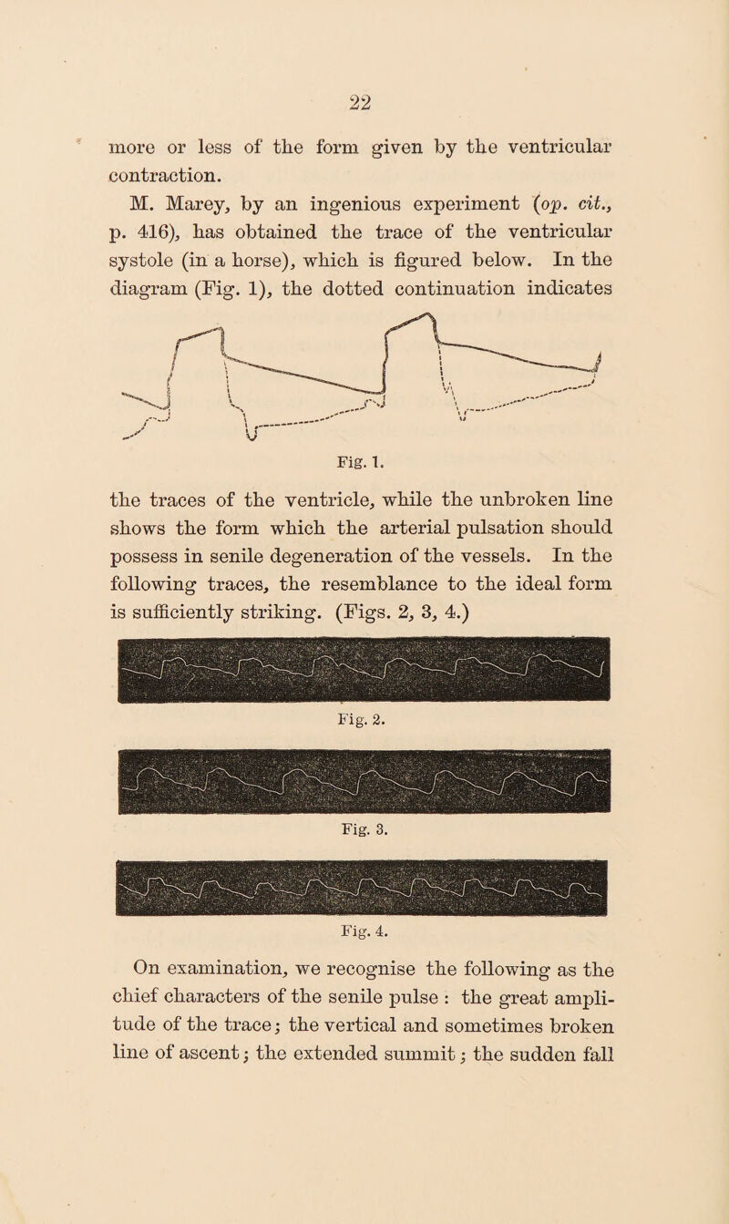 more or less of the form given by the ventricular contraction. M. Marey, by an ingenious experiment (op. cit., p. 416), has obtained the trace of the ventricular systole (in a horse), which is figured below. In the diagram (Fig. 1), the dotted continuation indicates the traces of the ventricle, while the unbroken line shows the form which the arterial pulsation should possess in senile degeneration of the vessels. In the following traces, the resemblance to the ideal form is sufficiently striking. (Figs. 2, 3, 4.) Fig. 4. On examination, we recognise the following as the chief characters of the senile pulse : the great ampli¬ tude of the trace; the vertical and sometimes broken line of ascent; the extended summit; the sudden fall