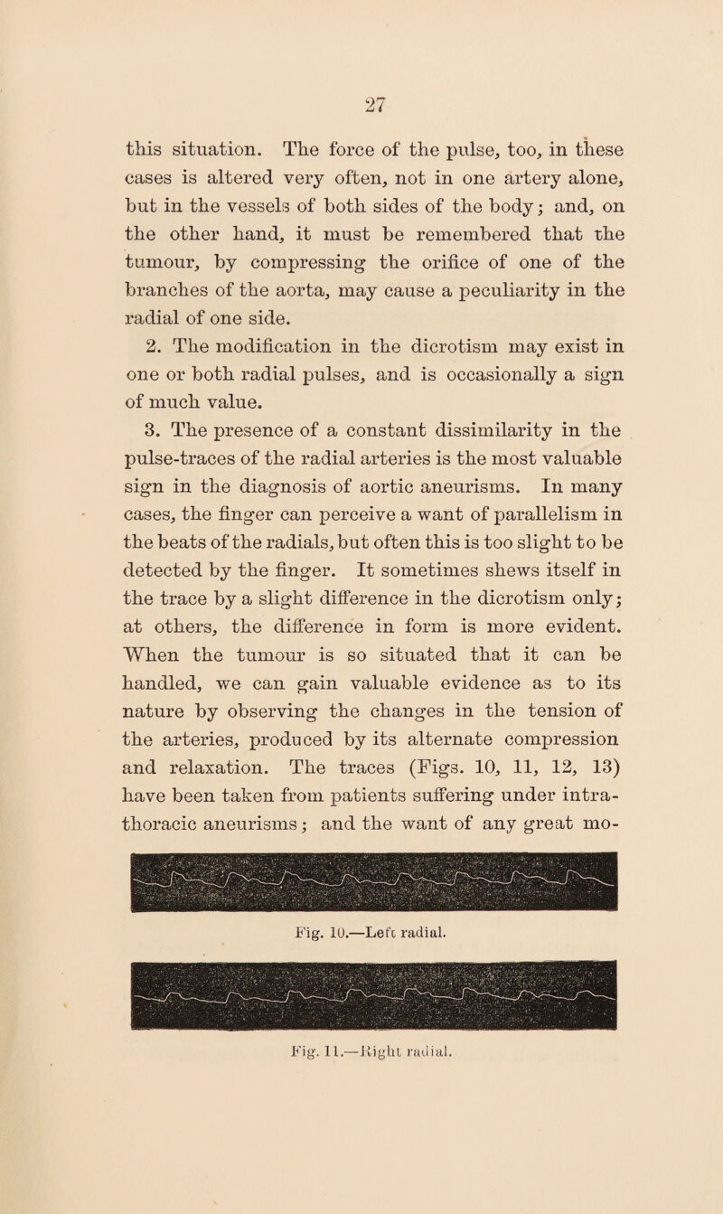 this situation. The force of the pulse, too, in these cases is altered very often, not in one artery alone, but in the vessels of both sides of the body; and, on the other hand, it must be remembered that the tumour, by compressing the orifice of one of the branches of the aorta, may cause a peculiarity in the radial of one side. 2. The modification in the dicrotism may exist in one or both radial pulses, and is occasionally a sign of much value. 3. The presence of a constant dissimilarity in the pulse-traces of the radial arteries is the most valuable sign in the diagnosis of aortic aneurisms. In many cases, the finger can perceive a want of parallelism in the beats of the radials, but often this is too slight to be detected by the finger. It sometimes shews itself in the trace by a slight difference in the dicrotism only; at others, the difference in form is more evident. When the tumour is so situated that it can be handled, we can gain valuable evidence as to its nature by observing the changes in the tension of the arteries, produced by its alternate compression and relaxation. The traces (Figs. 10, 11, 12, 13) have been taken from patients suffering under intra- thoracic aneurisms; and the want of any great mo- Fig. 10.—Lefc radial. Fig. 11.—Fight, radial.