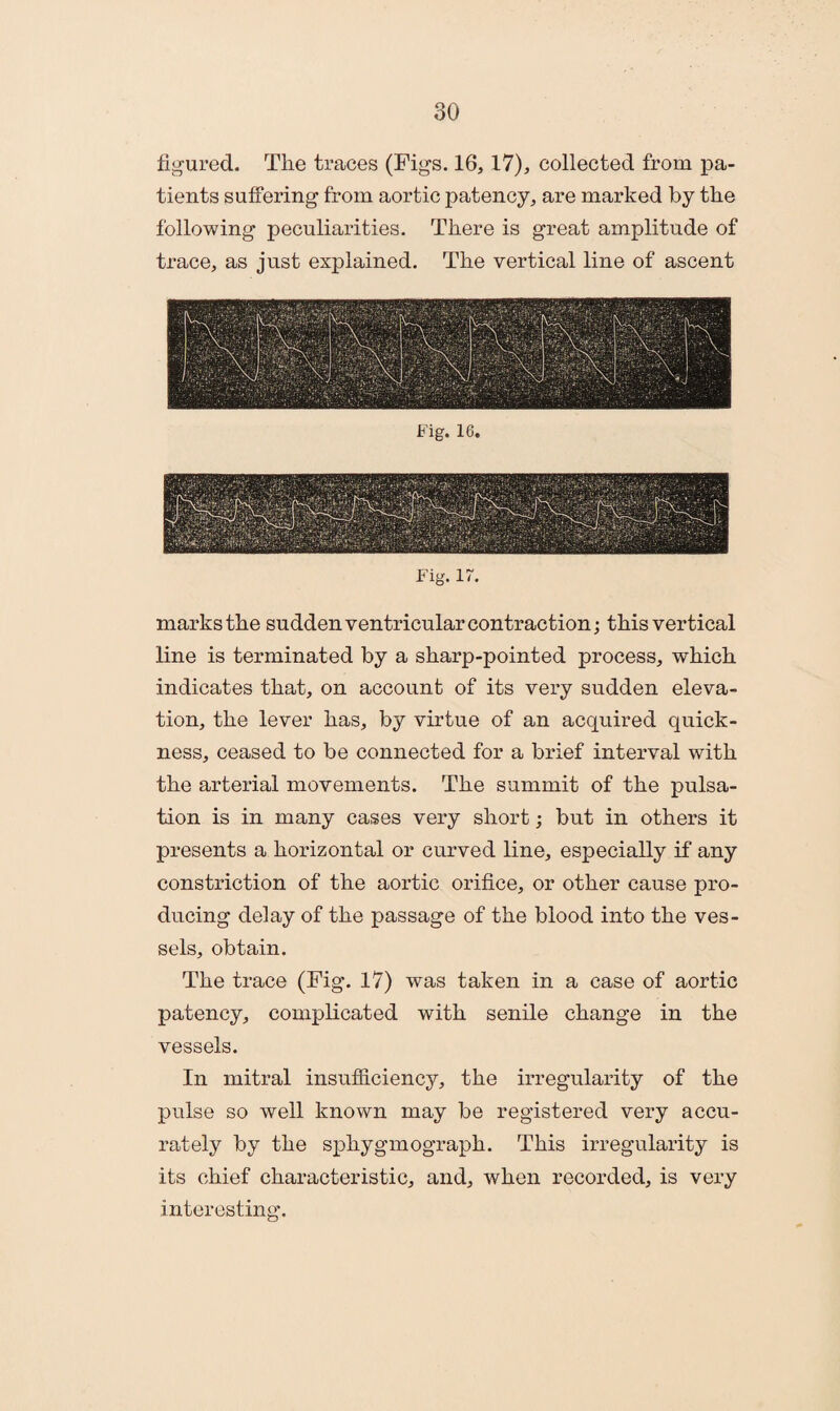 figured. Tlie traces (Figs. 16,17), collected from pa¬ tients suffering from aortic patency, are marked by the following peculiarities. There is great amplitude of trace, as just explained. The vertical line of ascent Fig. 16. Fig. 17. marks the sudden ventricular contraction; this vertical line is terminated by a sharp-pointed process, which indicates that, on account of its very sudden eleva¬ tion, the lever has, by virtue of an acquired quick¬ ness, ceased to be connected for a brief interval with the arterial movements. The summit of the pulsa¬ tion is in many cases very short; but in others it presents a horizontal or curved line, especially if any constriction of the aortic orifice, or other cause pro¬ ducing delay of the passage of the blood into the ves¬ sels, obtain. The trace (Fig. 17) was taken in a case of aortic patency, complicated with senile change in the vessels. In mitral insufficiency, the irregularity of the pulse so well known may be registered very accu¬ rately by the sphygmograph. This irregularity is its chief characteristic, and, when recorded, is very interesting.