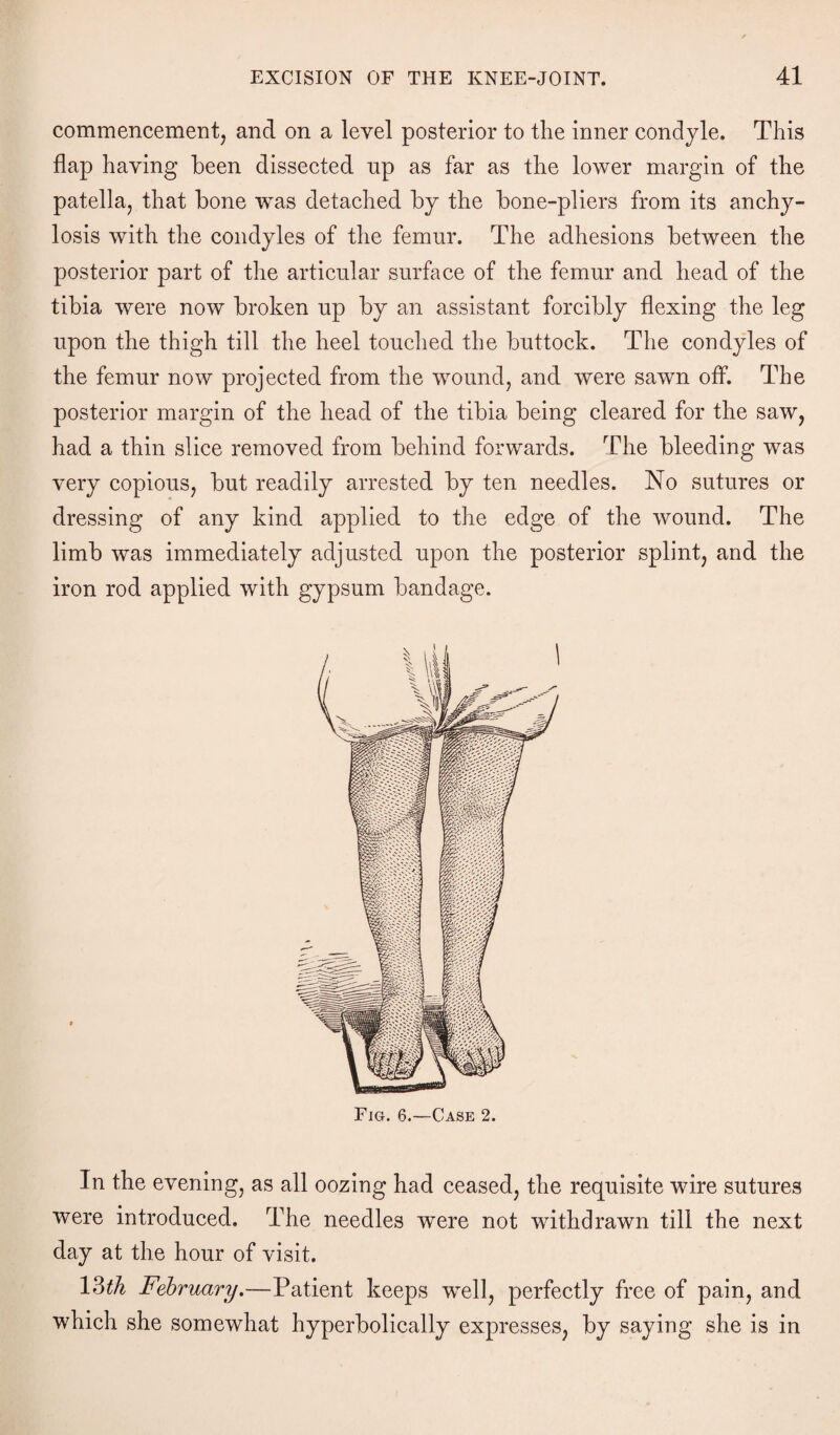 commencement, and on a level posterior to the inner condyle. This flap having been dissected np as far as the lower margin of the patella, that bone was detached by the bone-pliers from its anchy¬ losis with the condyles of the femur. The adhesions between the posterior part of the articular surface of the femur and head of the tibia were now broken up by an assistant forcibly flexing the leg upon the thigh till the heel touched the buttock. The condyles of the femur now projected from the wound, and were sawn off. The posterior margin of the head of the tibia being cleared for the saw, had a thin slice removed from behind forwards. The bleeding was very copious, but readily arrested by ten needles. No sutures or dressing of any kind applied to the edge of the wound. The limb was immediately adjusted upon the posterior splint, and the iron rod applied with gypsum bandage. Fig. 6.—Case 2. In the evening, as all oozing had ceased, the requisite wire sutures were introduced. The needles were not withdrawn till the next day at the hour of visit. 13th February.—Patient keeps well, perfectly free of pain, and which she somewhat hyperbolically expresses, by saying she is in