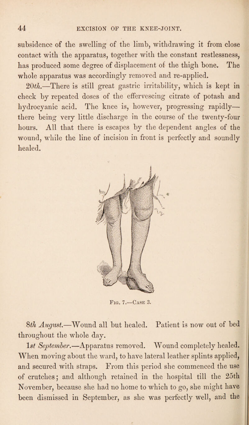 subsidence of the swelling of the limb, withdrawing it from close contact with the apparatus, together with the constant restlessness, has produced some degree of displacement of the thigh bone. The whole apparatus was accordingly removed and re-applied. 2Oth.—There is still great gastric irritability, which is kept in check by repeated doses of the effervescing citrate of potash and hydrocyanic acid. The knee is, however, progressing rapidly— there being very little discharge in the course of the twenty-four hours. All that there is escapes by the dependent angles of the wound, while the line of incision in front is perfectly and soundly healed. Fig. 7.—Case 3. 8ih August.—Wound all but healed. Patient is now out of bed throughout the whole day. Is? September.—Apparatus removed. Wound completely healed. When moving about the ward, to have lateral leather splints applied, and secured with straps. From this period she commenced the use of crutches; and although retained in the hospital till the 25th November, because she had no home to which to go, she might have been dismissed in September, as she was perfectly well, and the