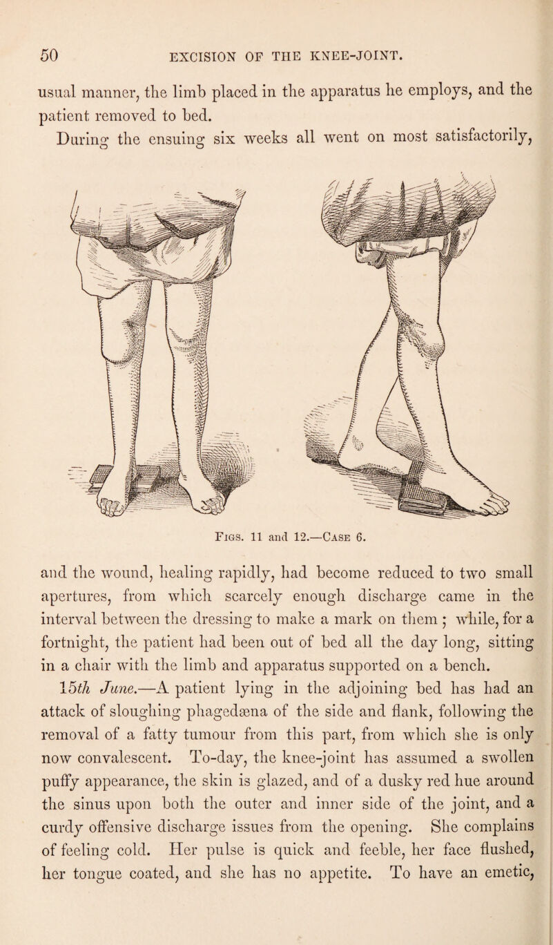 usual manner, the limb placed in the apparatus he employs, and the patient removed to bed. Durum the ensuing: six weeks all went on most satisfactorily, O O Figs. 11 and 12.—Case 6. and the wound, healing rapidly, had become reduced to two small apertures, from which scarcely enough discharge came in the interval between the dressing to make a mark on them ; while, for a fortnight, the patient had been out of bed all the day long, sitting in a chair with the limb and apparatus supported on a bench. 15th June.—A patient lying in the adjoining bed has had an attack of sloughing phagedsena of the side and flank, following the removal of a fatty tumour from this part, from which she is only now convalescent. To-day, the knee-joint has assumed a swollen puffy appearance, the skin is glazed, and of a dusky red hue around the sinus upon both the outer and inner side of the joint, and a curdy offensive discharge issues from the opening. She complains of feeling cold. Her pulse is quick and feeble, her face flushed, her tongue coated, and she has no appetite. To have an emetic,