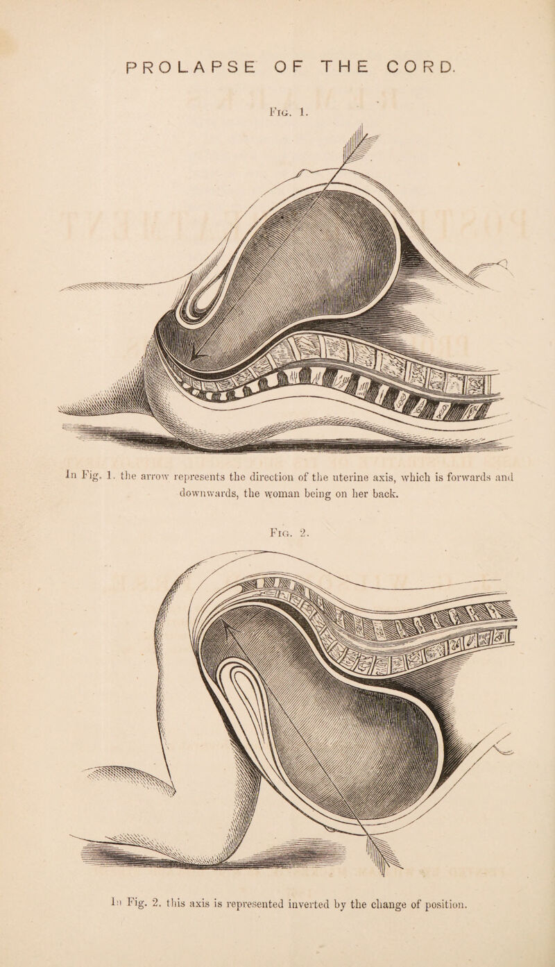 PROLAPSE OF THE CORD. Fig. 1. In big. 1. the arrow represents the direction of the uterine axis, which is forwards and downwards, the woman being on her back. Fig. 2.