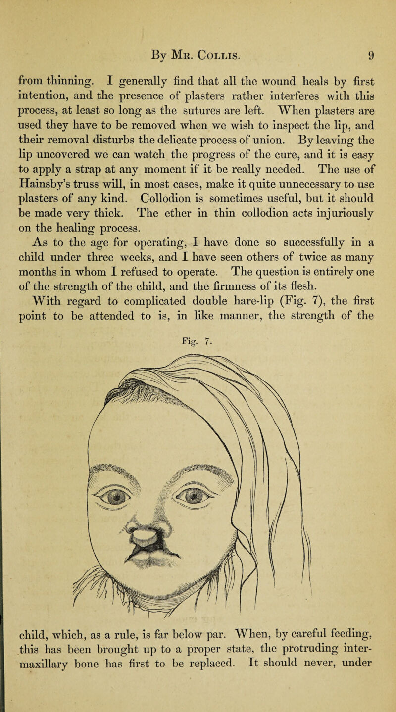 from thinning. I generally find that all the wound heals by first intention, and the presence of plasters rather interferes with this process, at least so long as the sutures are left. When plasters are used they have to be removed when we wish to inspect the lip, and their removal disturbs the delicate process of union. By leaving the lip uncovered we can watch the progress of the cure, and it is easy to apply a strap at any moment if it be really needed. The use of Hainsby’s truss will, in most cases, make it quite unnecessary to use plasters of any kind. Collodion is sometimes useful, but it should be made very thick. The ether in thin collodion acts injuriously on the healing process. As to the age for operating, I have done so successfully in a child under three weeks, and I have seen others of twice as many months in whom I refused to operate. The question is entirely one of the strength of the child, and the firmness of its flesh. With regard to complicated double hare-lip (Fig. 7), the first point to be attended to is, in like manner, the strength of the Fig. 7. child, which, as a rule, is far below par. When, by careful feeding, this has been brought up to a proper state, the protruding inter¬ maxillary bone has first to be replaced. It should never, under