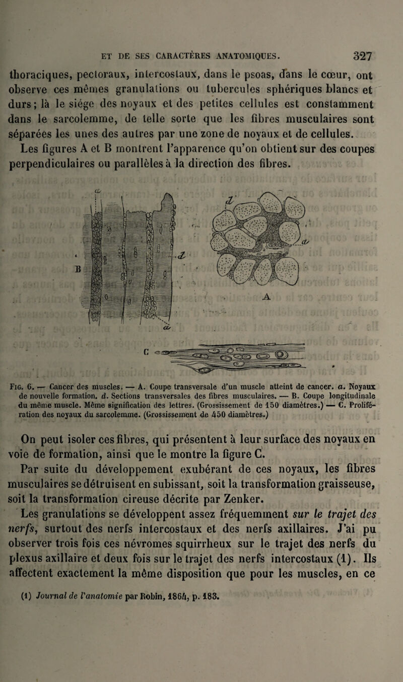 thoraciques, pectoraux, intercostaux, dans le psoas, dans le cœur, ont observe ces mêmes granulations ou tubercules sphériques blancs et durs; là le siège des noyaux et des petites cellules est constamment dans le sarcolemme, de telle sorte que les fibres musculaires sont séparées les unes des autres par une zone de noyaux et de cellules. Les figures A et B montrent l’apparence qu’on obtient sur des coupes perpendiculaires ou parallèles à la direction des fibres. Fig. 6. — Cancer des muscles» — A. Coupe transversale d’un muscle atteint de cancer, a. Noyaux de nouvelle formation, d. Sections transversales des fibres musculaires. — B. Coupe longitudinale du même muscle. Même signification des lettres. (Grossissement de 150 diamètres.) — C. Prolifé¬ ration des noyaux du sarcolemme. (Grossissement de 450 diamètres.) On peut isoler ces fibres, qui présentent à leur surface des noyaux en voie de formation, ainsi que le montre la figure C. Par suite du développement exubérant de ces noyaux, les fibres musculaires se détruisent en subissant, soit la transformation graisseuse, soit la transformation cireuse décrite par Zenker. Les granulations se développent assez fréquemment sur le trajet des nerfs, surtout des nerfs intercostaux et des nerfs axillaires. J’ai pu observer trois fois ces névromes squirrheux sur le trajet des nerfs du plexus axillaire et deux fois sur le trajet des nerfs intercostaux (1). Ils affectent exactement la même disposition que pour les muscles, en ce (1) Journal de Vanatomie par Robin, 1864, p. 183.