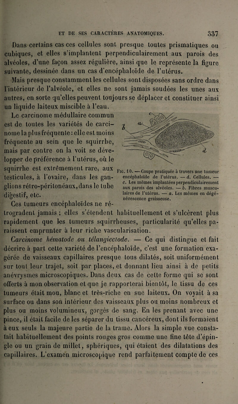 Dans certains cas ces cellules sont presque toutes prismatiques ou cubiques, et elles s’implantent perpendiculairement aux parois des alvéoles, d’une façon assez régulière, ainsi que le représente la figure suivante, dessinée dans un cas d’encéplialoïde de l’utérus. Mais presque constamment les cellules sont disposées sans ordre dans l’intérieur de l’alvéole, et elles ne sont jamais soudées les unes aux autres, en sorte qu’elles peuvent toujours se déplacer et constituer ainsi un liquide laiteux miscible à l’eau. Le carcinome médullaire commun est de toutes les variétés de carci¬ nome la p! us fréquente : elle est moins fréquente au sein que le squirrbe, mais par contre on la voit se déve¬ lopper de préférence à l’utérus, où le squirrbe est extrêmement rare, aux ~ .. , ., U ’ Fig. 10. — Coupe pratiquée a travers une tumeur testicules, à l’ovaire, dans les gan¬ glions rétro-péritonéaux,dans le tube digestif, etc. Ces tumeurs encéphaloïdes ne ré¬ trogradent jamais ; elles s’étendent habituellement et s’ulcèrent plus rapidement que les tumeurs squirrheuses, particularité qu’elles pa¬ raissent emprunter à leur riche vascularisation. Carcinome hématode ou lélancjieclode. — Ce qui distingue et fait décrire à part cette variété de l’encéphaloïde, c’est une formation exa¬ gérée de vaisseaux capillaires presque tous dilatés, soit uniformément sur tout leur trajet, soit par places, et donnant lieu ainsi à de petits anévrysmes microscopiques. Dans deux cas de cette forme qui se sont offerts à mon observation et que je rapporterai bientôt, le tissu de ces tumeurs était mou, blanc et très-riche en suc laiteux. On voyait à sa surface ou dans son intérieur des vaisseaux plus ou moins nombreux et plus ou moins volumineux, gorgés de sang. En les prenant avec une pince, il était facile de les séparer du tissu cancéreux, dont ils formaient à eux seuls la majeure partie de la trame. Alors la simple vue consta¬ tait habituellement des points rouges gros comme une fine tête d’épin¬ gle ou un grain de millet, sphériques, qui étaient des dilatations des capillaires. L’examen microscopique rend parfaitement compte de ces encéphaloïde de l’utérus. — d. Cellules. — c. Les mêmes implantées perpendiculairement aux parois des alvéoles. — b. Fibres muscu¬ laires de l’utérus, nérescence graisseuse. a. Les mêmes en dégé~