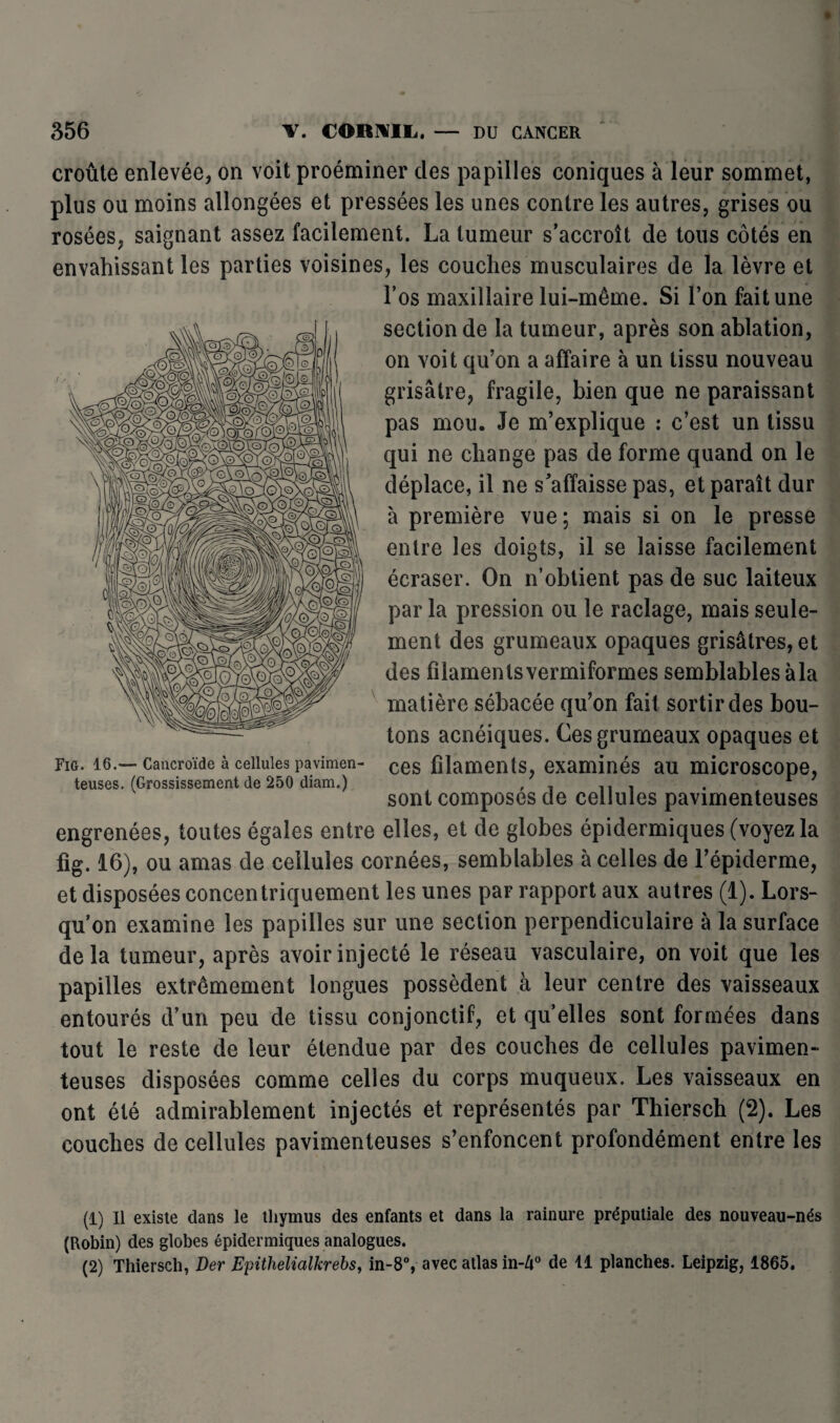 croûte enlevée, on voit proéminer des papilles coniques à leur sommet, plus ou moins allongées et pressées les unes contre les autres, grises ou rosées, saignant assez facilement. La tumeur s’accroît de tous côtés en envahissant les parties voisines, les couches musculaires de la lèvre et l’os maxillaire lui-même. Si l’on fait une section de la tumeur, après son ablation, on voit qu’on a affaire à un tissu nouveau grisâtre, fragile, bien que ne paraissant pas mou. Je m’explique : c’est un tissu qui ne change pas de forme quand on le déplace, il ne s'affaisse pas, et paraît dur à première vue; mais si on le presse entre les doigts, il se laisse facilement écraser. On n’obtient pas de suc laiteux par la pression ou le raclage, mais seule¬ ment des grumeaux opaques grisâtres, et des filamentsvermiformes semblables àla matière sébacée qu’on fait sortir des bou¬ tons acnéiques. Ces grumeaux opaques et ces filaments, examinés au microscope, sont composés de cellules pavimenteuses engrenées, toutes égales entre elles, et de globes épidermiques (voyez la fig. 16), ou amas de cellules cornées, semblables à celles de l’épiderme, et disposées concentriquement les unes par rapport aux autres (1). Lors¬ qu’on examine les papilles sur une section perpendiculaire à la surface delà tumeur, après avoir injecté le réseau vasculaire, on voit que les papilles extrêmement longues possèdent à leur centre des vaisseaux entourés d’un peu de tissu conjonctif, et qu elles sont formées dans tout le reste de leur étendue par des couches de cellules pavimen¬ teuses disposées comme celles du corps muqueux. Les vaisseaux en ont été admirablement injectés et représentés par Thiersch (2). Les couches de cellules pavimenteuses s’enfoncent profondément entre les Fig. 16.— Cancroïde à cellules pavimen¬ teuses. (Grossissement de 250 diam.) (1) 11 existe dans le thymus des enfants et dans la rainure préputiale des nouveau-nés (Robin) des globes épidermiques analogues. (2) Thiersch, Der Epithelialkrebs, in-8°, avec atlas in-A° de 11 planches. Leipzig, 1865.