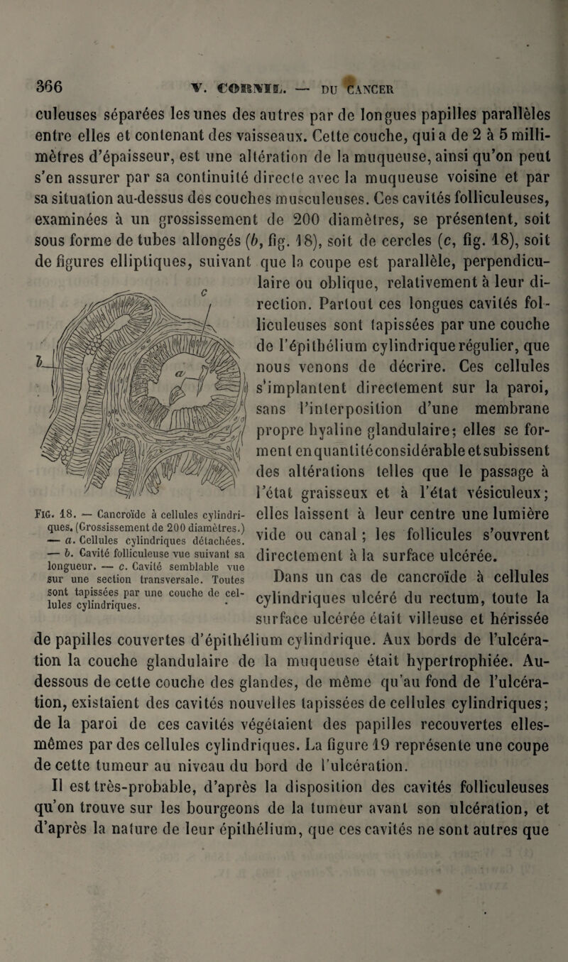 culeuses séparées les unes des autres par de longues papilles parallèles entre elles et contenant des vaisseaux. Cette couche, qui a de 2 à 5 milli¬ mètres d'épaisseur, est une altération de la muqueuse, ainsi qu'on peut s’en assurer par sa continuité directe avec la muqueuse voisine et par sa situation au-dessus des couches musculeuses. Ces cavités folliculeuses, examinées à un grossissement de 200 diamètres, se présentent, soit sous forme de tubes allongés (b, fig. 18), soit de cercles (c, fig. 18), soit de figures elliptiques, suivant que la coupe est parallèle, perpendicu¬ laire ou oblique, relativement à leur di¬ rection. Partout ces longues cavités fol¬ liculeuses sont tapissées par une couche de P épithélium cylindrique régulier, que nous venons de décrire. Ces cellules s‘implantent directement sur la paroi, sans l'interposition d’une membrane propre hyaline glandulaire; elles se for¬ ment enquanliléconsidérableetsubissent des altérations telles que le passage à Tétât graisseux et à l’état vésiculeux; Fig. 18. — Cancroïde à cellules cyiindri- elles laissent à leur centre une lumière - vide ou canal ; les follicules s’ouvrent — 6. Cavité foiiicuieuse vue suivant sa directement à la surface ulcérée. longueur. — c. Cavité semblable vue _ M x . sur une section transversale. Toutes Dans Ull Cas de Cancroïde à Cellules îukVc^iindriqueT Une couche dG .ceI cylindriques ulcéré du rectum, toute la surface ulcérée était villeuse et hérissée de papilles couvertes d’épithélium cylindrique. Aux bords de l’ulcéra¬ tion la couche glandulaire de la muqueuse était hypertrophiée. Au- dessous de cette couche des glandes, de même qu’au fond de l’ulcéra¬ tion, existaient des cavités nouvelles tapissées de cellules cylindriques; de la paroi de ces cavités végétaient des papilles recouvertes elles- mêmes par des cellules cylindriques. La figure 19 représente une coupe de cette tumeur au niveau du bord de l'ulcération. Il est très-probable, d’après la disposition des cavités folliculeuses qu’on trouve sur les bourgeons de la tumeur avant son ulcération, et d’après la nature de leur épithélium, que ces cavités ne sont autres que