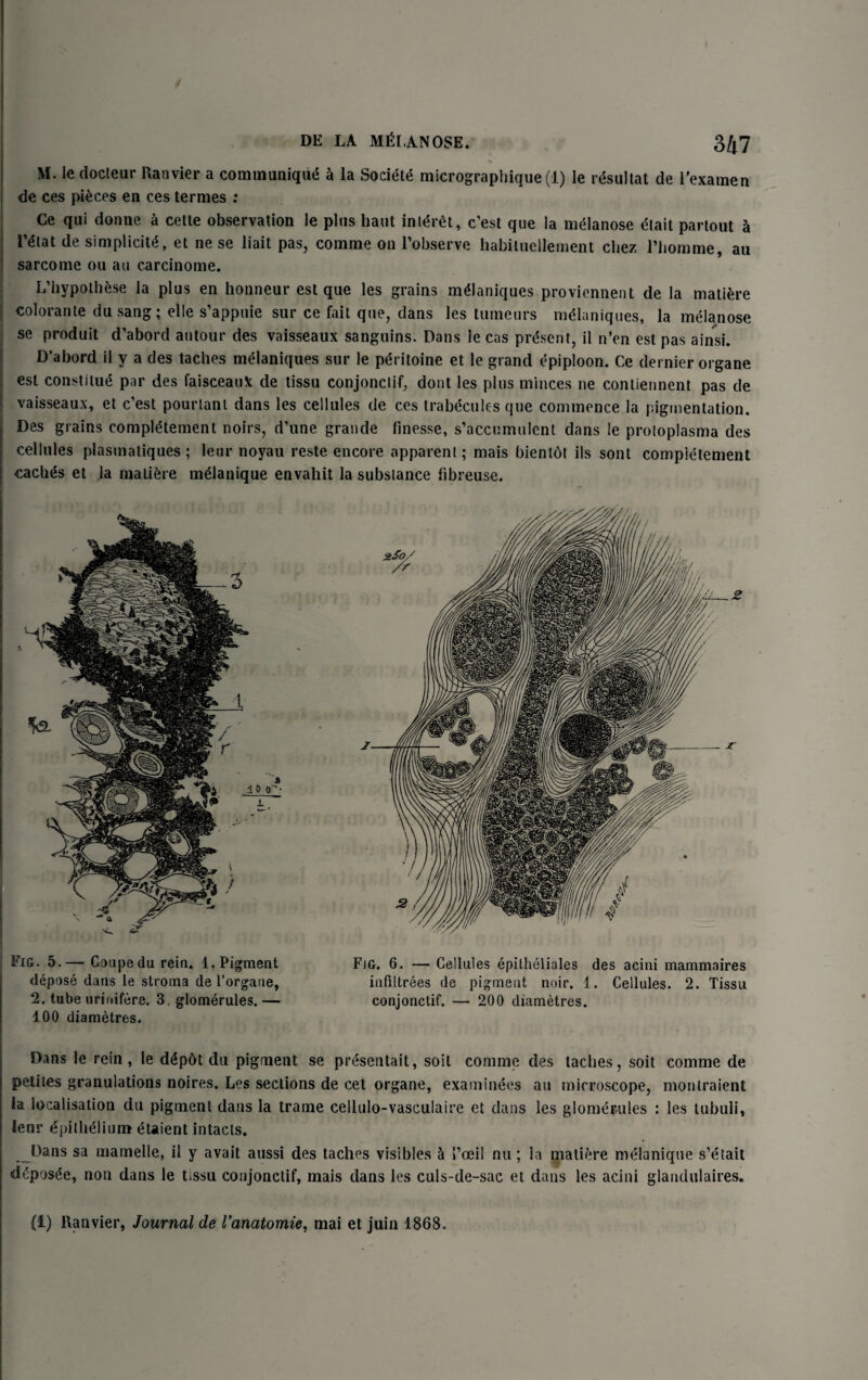 J DE LA MELANOSE. 3J7 M. le docteur Ranvier a communique a la Society micrographique (1) le rdsultat de l’examen de ces pieces en ces termes ; Ce qui donne a cetle observation le plus haut inl<5r6t, c’est que la melanose dtait partout h reiat de simplicity et ne se liait pas, comme on l’observe habituellement cliez l’liomme, au sarcome ou au carcinome. L’hypothese la plus en honneur est que les grains mdlaniques proviennent de la matiere colorante dusang; elle s’appuie sur ce fait que, dans les tumeurs meianiques, la melanose se produit d’abord antour des vaisseaux sanguins. Dans le cas present, il n’en est pas ainsi. D’abord il y a des taches melaniques sur le peritoine et le grand epiploon. Ce dernier organe est constitue par des faisceau* de tissu conjonctif, dont les plus minces ne contiennent pas de vaisseaux, et c’est pourlanl dans les cellules de ces trablcules que commence la pigmentation. Des grains completement noirs, d’une grande finesse, s’a ecu mu lent dans le protoplasma des cellules plasmatiques ; leur noyau reste encore apparent; mais bientot ils sont completement caches et la matiere m&anique envahit la substance fibreuse. Fig. 5.— Coupe du rein. 1. Pigment depose dans le stroma de l’organe, 2. tube urinifere. 3. glomerules. — 100 diametres. Fjg. 6. — Cellules epitheliales des acini mammaires infiltrees de pigment noir. 1. Cellules. 2. Tissu conjonctif. — 200 diametres. Dans le rein, le ddpot du pigment se presentait, soil comme des laches, soit comme de petites granulations noires. Les sections de cet organe, examinees au microscope, monlraient la localisation du pigment dans la trame celiulo-vasculaire et dans les glomerules : les tubuii, leur y>itli61ium etaient intacts. Dans sa mamelle, il y avait aussi des taches visibles h 1’oeil nu; la matiere melanique s’etait d£pos£e, non dans le tissu conjonctif, mais dans les culs-de-sac et dans les acini glandulaires.
