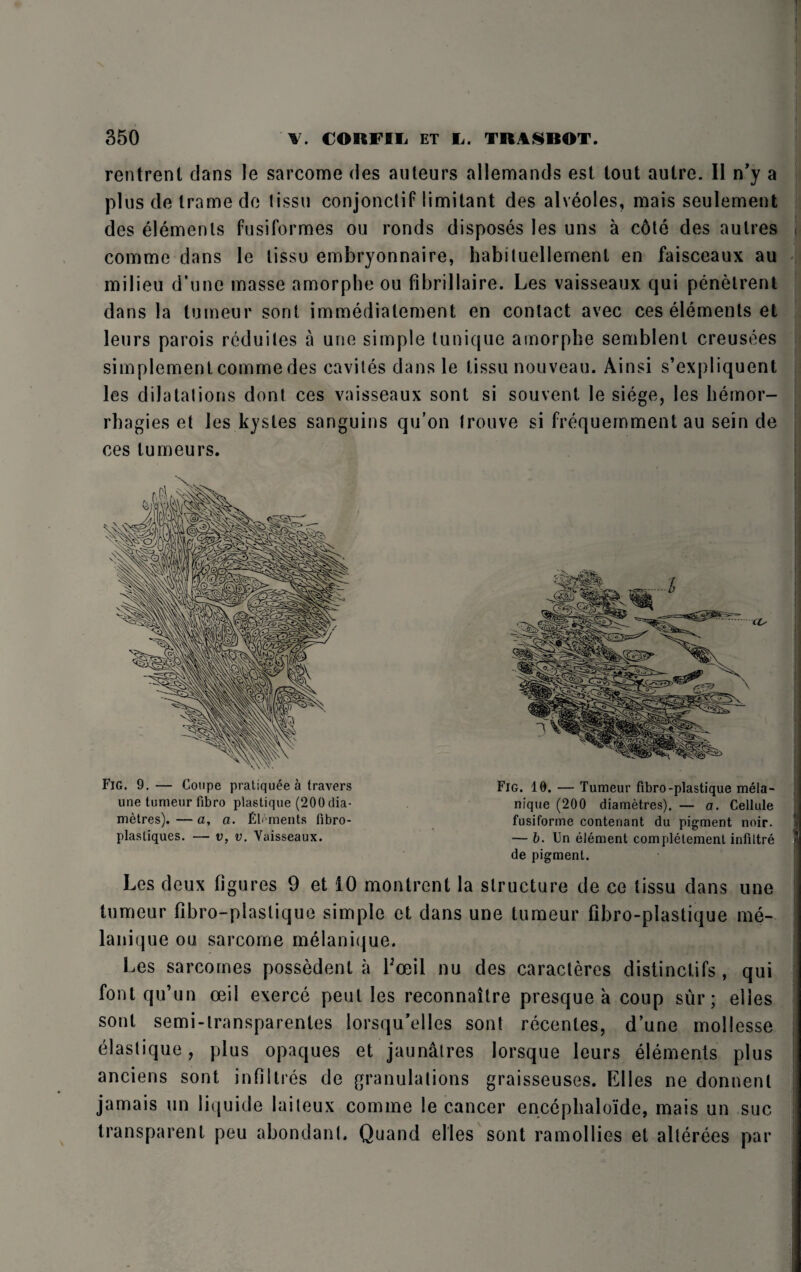 rentrent clans le sarcome des auteurs allemands est tout autre. II n’y a plus cle trame de tissu conjonctif limitant des alveoles, mais seulement des elements fusiformes ou ronds disposes les uns a c6te des aulres | comme dans le tissu embryonnaire, habituellement en faisceaux au milieu d’une masse amorphe ou fibrillaire. Les vaisseaux qui penetrent dans la tumeur sont immediatement en contact avec ces elements et leurs parois recluiles a une simple lunique amorphe semblenl creusees simplement comme des caviles dans le tissu nouveau. Ainsi s’expliquent les dilatations dont ces vaisseaux sont si souvent le siege, les hemor- rhagies et les kystes sanguins qu’on trouve si frequemment au sein de ces tumeurs. Fig. 9. — Coupe pratiquee a travers Fig. 10. — Tumeur fibro-plastique mela- une tumeur fibro plastique (200dia- nique (200 diametres). — a. Cellule metres). — a, a. Elements fibro- fusiforme contenant du pigment noir. plasliques. — v, v. Vaisseaux. — 6. Un element complelemenl infiitre ? de pigment. Les deux figures 9 et 10 montrent la structure de ce tissu dans une tumeur fibro-plastique simple ct dans une tumeur fibro-plastique me- lanique ou sarcome melanique. Les sarcomes possedent a boeil nu des caracteres distinclifs , qui I font qu’un oeil exerce pent les reconnaitre presque a coup siir; elles sont semi-lransparentes lorsqu’elles sont recentes, d’une mollesse elastique, plus opaques et jaunalres lorsque leurs elements plus anciens sont inf! I ires de granulations graisseuses. Elles ne donnenl jamais un liquide laiteux comme le cancer encepbaloide, mais un sue transparent peu abondant. Quand elles sont ramollies et alterees par j