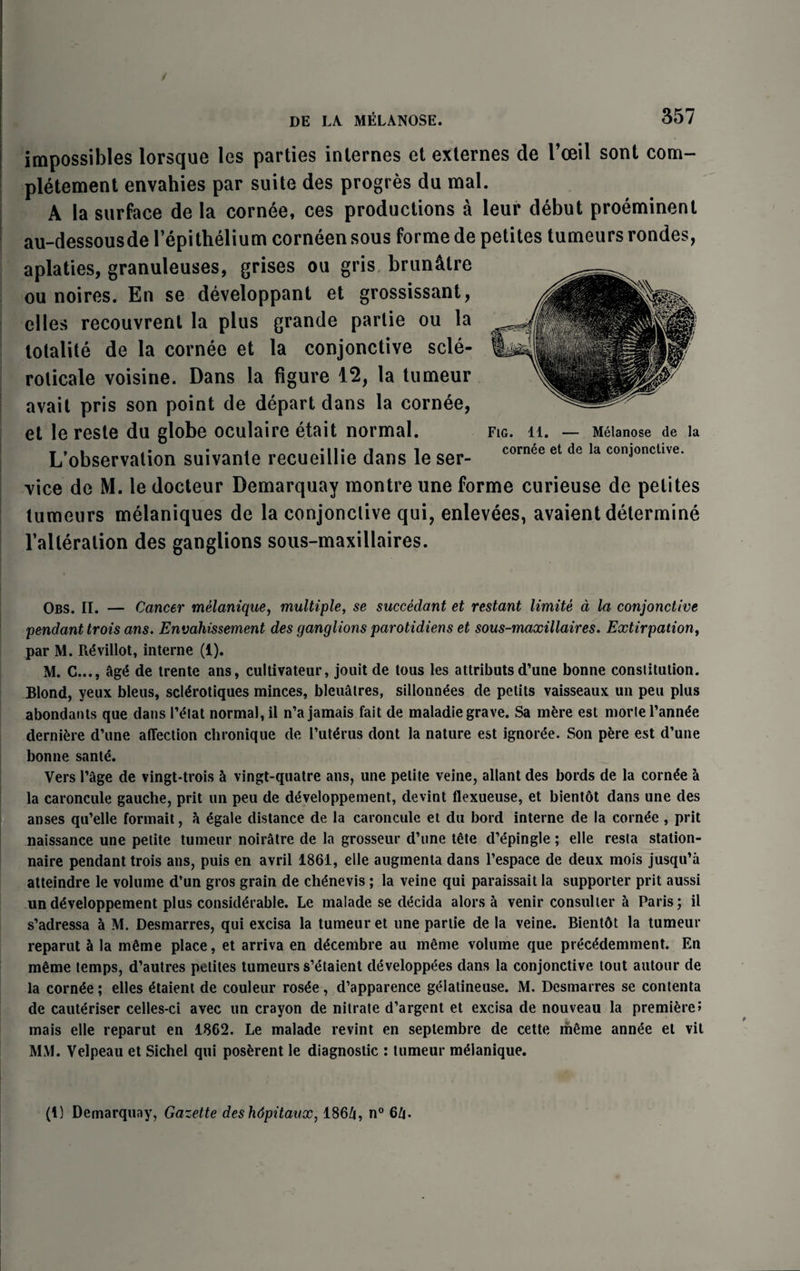 / DE LA. MELANOSE. 357 impossibles lorsque les parties internes et externes de l’ceil sont com- pletement envahies par suite des progres du mal. A la surface de la cornee, ces productions a leur debut proeminent au-dessousde l’epithelium corneen sous forme de petites tumeurs rondes, aplaties, granuleuses, grises ou gris brun&tre ou noires. En se developpant et grossissant, dies recouvrent la plus grande partie ou la totalite de la cornee et la conjonctive scle- rolicale voisine. Dans la figure 12, la tumeur avail pris son point de depart dans la cornee, et le reste du globe oculaire etait normal. L’observalion suivanle recueillie dans le ser¬ vice de M. le docteur Demarquay montre une forme curieuse de petites tumeurs melaniques de la conjonctive qui, enlevees, avaient determine 1’alteralion des ganglions sous-maxillaires. Fig. 11. — Melanose de la cornee et de la conjonctive. Obs. II. — Cancer melanique, multiple, se succedant et restant limite d la conjonctive pendant trois ans. Envahissement des ganglions parotidiens et sous-maxillaires. Extirpation, par M. Rdvillot, interne (1). M. C..., Sgd de trente ans, cultivateur, jouit de tous les attributs d’une bonne constitution. Blond, yeux bleus, scldrotiques minces, bleuatres, sillonndes de petits vaisseaux un peu plus abondants que dans Petal normal, il n’a jamais fait de maladie grave. Sa mdre est morlel’annde dernidre d’une affection chronique de l’utdrus dont la nature est ignorde. Son pere est d’une bonne santd. Vers Page de vingt-trois h vingt-quatre ans, une petite veine, allant des bords de la cornde a la caroncule gauche, prit un peu de ddveloppement, devint flexueuse, et bientot dans une des anses qu’elle formait, h egale distance de la caroncule et du bord interne de la cornde , prit naissance une petite tumeur noiratre de la grosseur d’une tdte d’dpingle; elle resta station- naire pendant trois ans, puis en avril 1861, elle augmenta dans l’espace de deux mois jusqu’a atteindre le volume d’un gros grain de chdnevis; la veine qui paraissait la supporter prit aussi un ddveloppement plus considerable. Le malade se ddcida alors a venir consul ter a Paris; il s’adressa a M. Desmarres, qui excisa la tumeur et une partie de la veine. Bientbt la tumeur reparut h la mdme place, et arriva en ddcembre au merne volume que precddemment. En meme temps, d’autres petites tumeurs s’etaient ddveloppees dans la conjonctive tout autour de la cornde; elles dtaient de couleur rosde, d’apparence gelatineuse. M. Desmarres se contenta de cauteriser celles-ci avec un crayon de nitrate d’argent et excisa de nouveau la premidreJ mais elle reparut en 1862. Le malade revint en septembre de cette meme annde et vit MM. Velpeau et Sichel qui posdrent le diagnostic : tumeur mdlanique.