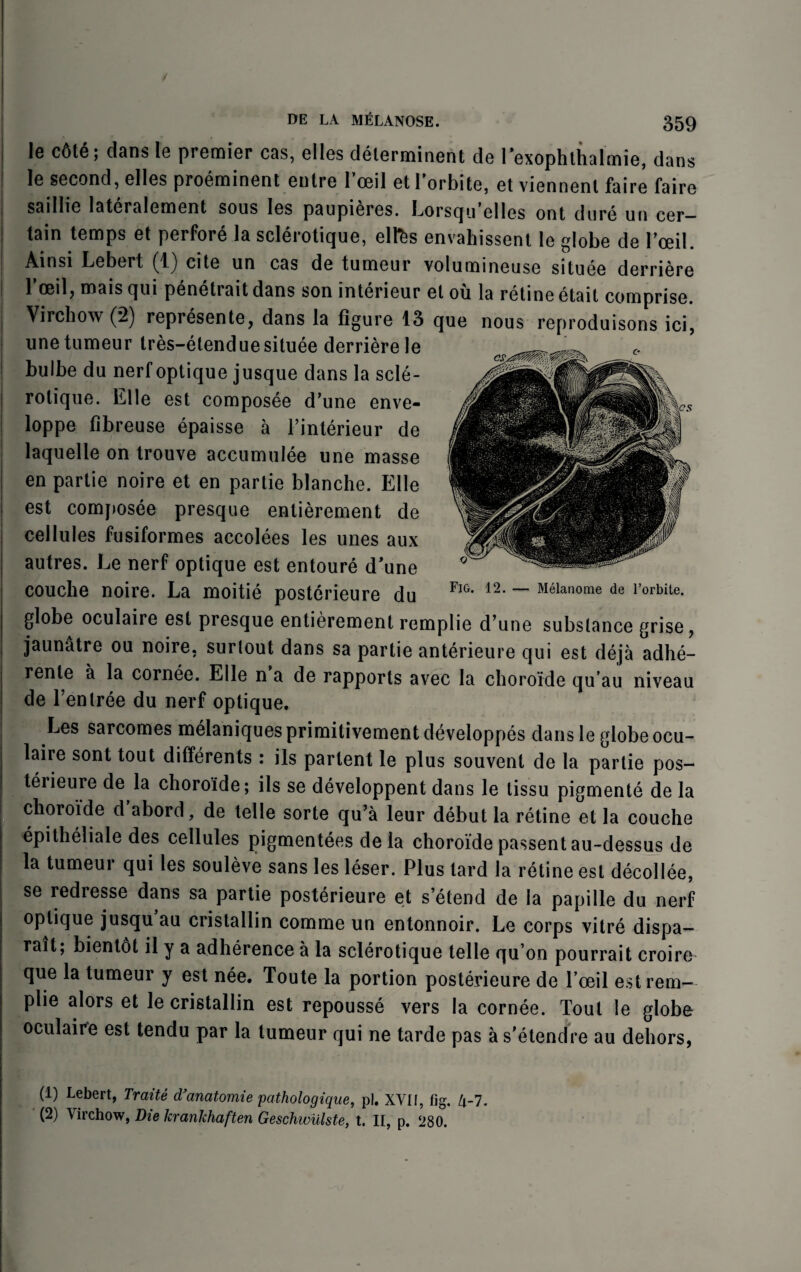 I ✓ DE LA MfiLANOSE. 359 le c6t6; dans le premier cas, elles delerminent de rexophthalmie, dans le second, elles proeminent enlre l’ceil et 1’orbite, et viennent faire faire saillie lateralement sous les paupieres. Lorsqu’elles ont dure un cer¬ tain temps et perfore la sclerotique, ell^s envahissent le globe de Toeil. Ainsi Lebert (1) cite un cas de tumeur volumineuse situee derriere Tceil, mais qui penetrait dans son interieur et oil la retine etait comprise. Virchow (*2) represente, dans la figure 13 que nous reproduisons ici, une tumeur tres-elenduesituee derriere le bulbe du nerfoptique jusque dans la scle¬ rotique. Elle est composee d’une enve- loppe fibreuse epaisse a l’interieur de laquelle on trouve accumulee une masse en partie noire et en partie blanche. Elle est composee presque entierement de cellules fusiformes accolees les unes aux autres. Le nerf optique est entoure d’une couche noire. La moitie posterieure du globe oculaire est presque entierement remplie d’une substance grise, jaunatre ou noire, surtout dans sa partie anterieure qui est deja adhe- rente a la cornee. Elle n a de rapports avec la choroide qu’au niveau de fen tree du nerf optique. Fig. 12. — Melanome de l’orbite. Les sarcomes melaniquesprimitivementdeveloppes dans le globe ocu¬ laire sont tout differents : its partent le plus souvent de la partie pos- teiieure de la choroide; ils se developpent dans le tissu pigmente de la choroide d abord, de telle sorte qu’a leur debut la retine et la couche epitheliale des cellules pigmentees de la choroide passentau-dessus de la tumeur qui les souleve sans les leser. Plus lard la retine est decollee, se redresse dans sa partie posterieure et s’etend de la papille du nerf optique jusqu au cristallin comme un entonnoir. Le corps vitre dispa— rait; bientdt il y a adherence a la sclerotique telle qu’on pourrait croire que la tumeur y est nee. Toute la portion posterieure de foeil est rem- plie alors et le cristallin est repousse vers la cornee. Tout le globe oculaire est tendu par la tumeur qui ne tarde pas as’etendre au dehors, (1) Lebert, Traite d’anatomie pathologique, pi. XVII, fig. 4-7.