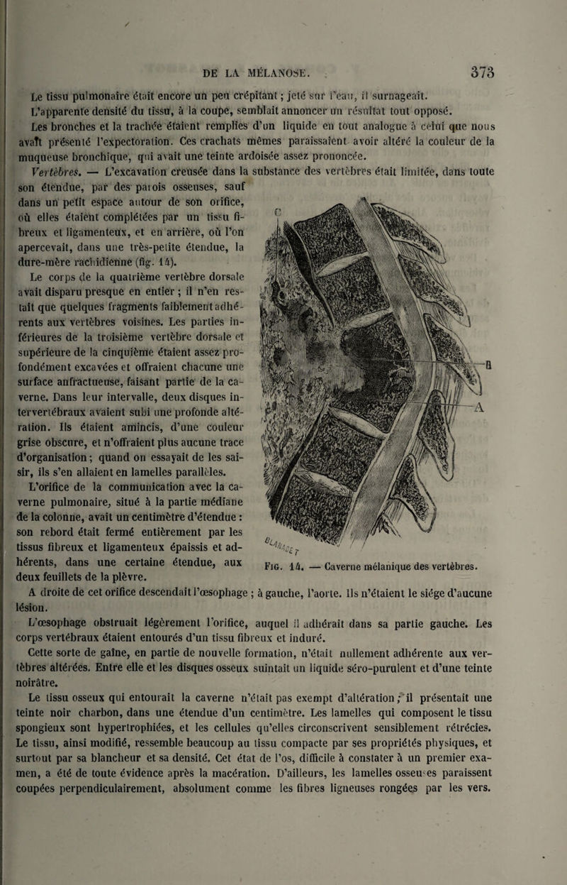 Le tissu pulmonaire etait encore un pen crepitant; jele sur Peau, il surnageait. L’apparente densite du tissu, a la coupe, semblait annoncer un resuitat tout oppose. Les bronches et la traclie etaient remplies d’un liquide en tout analogue a celui que nous avaTt presente l’expectoration. Ces crachats memes paraissaient avoir altdre la couleur de la muqueuse bronchique, qui avail une teinte ardoisee assez prononcee. Vertebres. — L’excavation crehsee dans la substance des vertebres etait limitee, dans toute son etendue, par des paiois osseuses, sauf dans un petit espace autour de son orifice, ou elles etaient compl^tees par un tissu fi- breux et ligamenteux, et en arrive, ou Pon apercevait, dans une tres-pelite etendue, la dure-m£re raciiidienne (fig. 14). Le corps de la quatrieme vertfebre dorsale avait disparu presque en entier; il n’en res- tait que quelques fragments faibleinentadhe¬ rents aux vertebres voisines. Les parties in- ferieures de la troisieme vertebre dorsale et superieure de la cinquime etaient assez pro- fondement excavees et offraient chacune une surface anfractueuse, faisant partie de la ca- verne. Dans leur intervalle, deux disques in- tervertebraux avaient subi une profonde alte¬ ration. Ils etaient amincis, d’une couleur grise obscure, et n’offraient plus aucune trace d’organisation; quand on essayait de les sai- sir, ils s’en allaient en lamelles paralleles. L’orifice de la communication avec la ca- verne pulmonaire, situe & la partie mediane de la colonne, avait un centimetre d’etendue: son rebord etait ferme entirement par les tissus fibreux et ligamenteux dpaissis et ad¬ herents, dans une certaine etendue, aux deux feuillets de la plfcvre. A droite de cet orifice descendait 1’oesophage ; h gauche, Paorte. Ils n’etaient le siege d’aucune lesion. L’oesophage obstruait legdrement l’orifice, auquel il adlidrait dans sa partie gauche. Les corps vertebraux etaient entoures d’un tissu fibreux et indure. Cette sorte de gaine, en partie de nouvelle formation, n’etait nullement adherente aux ver- tfcbres alterees. Entre elle et les disques osseux suintait un liquide sero-purulent et d’une teinte noiratre. Le tissu osseux qui entourait la caverne n’elait pas exempt d’alteration; il presentait une teinte noir charbon, dans une etendue d’un centimetre. Les lamelles qui composent le tissu spongieux sont hypertrophies, et les cellules qu’elles circonscrivent sensiblement litiicies. Le tissu, ainsi modifie, ressemble beaucoup au tissu compacte par ses proprites physiques, et surtout par sa blancheur et sa densite. Cet etat de l’os, difficile h constater a un premier exa- men, a ete de toute Evidence apr£s la maceration. D’ailleurs, les lamelles osseu es paraissent coupdes perpendiculairement, absolument comme les fibres ligneuses rongees par les vers.
