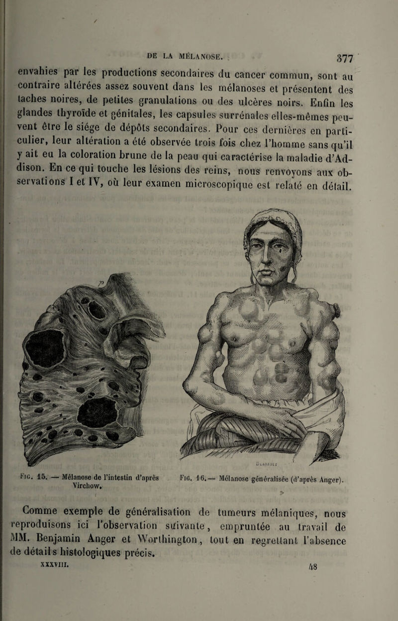 / DE LA MELANOSE. 377 envahies par les productions secondaires du cancer commun, sont au contraire alterees assez souvent dans les melanoses et presentent des laches noires, de petites granulations on des ulceres noirs. Enfin les glandes thyroide et genitales, les capsules surrenalcs elles-m&mes pou- vent dtre le siege de depots secondaires. Pour ces deroieres on parti¬ cular, leur alteration a ele observee trois fois chez l’hornme sans qu’il y ait eu la coloration brune de la peau qui caracterise la maladie d’Ad- dison. En ce qui touche les lesions des reins, nous rcnvoyons aux ob¬ servations I et IV, oil leur examen microscopique est relate en detail. Fig. 15. — Melanose de l’intestin d’apres Fig. 16.— Melanose gendralisee (d’apres Anger). Virchow, i > Gomme exemple de generalisation de tumours melaniques, nous reproduisons ici l’observation suivante, empruntee au travail de MM. Benjamin Anger et Worthington, lout en regretlant l’absence de details histologiques precis. XXXVIII. f.Q