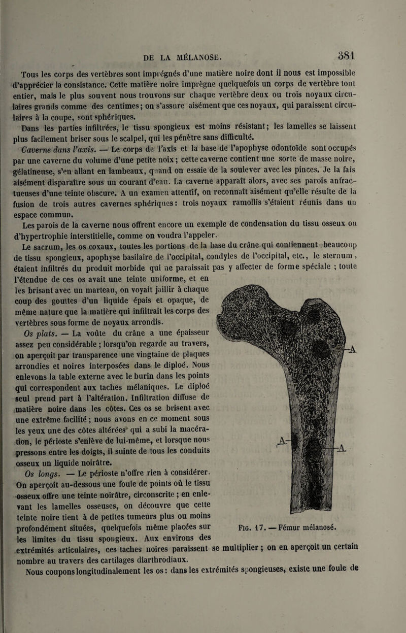 Tous les corps des vertebres sont impregnes d’une mattere noire dont il nous est impossible d’appr^cier la consistance. Cette mature noire impregne quelquefois un corps de vertebre tout entier, mais le plus souvent nous trouvons sur chaque vertebre deux ou trois noyaux circu- laires grands comme des centimes; on s’assure aisement que cesnoyaux, qui paraissent circu- laires & la coupe, sont splteriques. Dans les parties infiltrees, le tissu spongieux est moins resistant; les lamelles se laissent plus facilement briser sous le scalpel, qui lesp<5n£tre sans difliculte. Caverne dans Vaxis. — Le corps de Taxis et la base de l’apophyse odontoide sont occupes par une caverne du volume d’une petite noix; cette caverne contient une sorte de masse noire, gelatineuse, s’cn allant en lambeaux, quand on essaie de la soulever avecles pinces. Je la fais aisement disparaitre sous un courant d’eau. La caverne apparait alors, avec ses parois anfrac- tueuses d’une teinte obscure. A un examen attentif, on reconnait aisement qu’elle resulte de la fusion de trois autres cavernes spheriques: trois noyaux ramollis s’etaient reunis dans uu espace commun. Les parois de la caverne nous offrent encore un exemple de condensation du tissu osseux ou d’hypertrophie interstitielle, comme on voudra Tappeler. Le sacrum, les os coxaux, toutes les portions de la base du crane qui contiennent beaucoup de tissu spongieux, apophyse basilaire de i’occipital, condyles de Toccipital, etc., le sternum , etaient infiltres du produit morbide qui ne paraissait pas y atfecter de forme speciale ; toule l’etendue de ces os avait une teinte uniforme, et en les brisant avec un marteau, on voyait jaillir & chaque coup des goultes d’un liquide £pais et opaque, de nteme nature que la matiere qui infiltrait les corps des vertebres sous forme de noyaux arrondis. Os plats. — La voute du crane a une ^paisseur assez peu considerable ; lorsqu’on regarde au travers, on apercoit par transparence une vingtaine de plaques arrondies et noires interposes dans le diploe. Nous enlevons la table externe avec le burin dans les points qui correspondent aux taches ntelaniques. Le diploe seul prend part h Talteralion. Infiltration diffuse de matiere noire dans les cotes. Ces os se brisent avec une extreme facility ; nous avons en ce moment sous les yeux une des cdtes alterdes' qui a subi la macera¬ tion, le perioste s’enleve de lui-meme, et lorsque nous pressons entre les doigts, il suinte de tous les conduits osseux un liquide noir&tre. Os longs. — Le perioste n’offre rien h considered On apercoit au-dessous une foule de points oil le tissu osseux offre une teinte noiratre, circonscrite ; en enle- vant les lamelles osseuses, on decouvre que cette teinte noire tient & de petites tumeurs plus ou moins profondement situees, quelquefois meme placees sur Fig. 17.—Femur melanosS. les limites du tissu spongieux. Aux environs des extr^mites articulaires, ces taches noires paraissent se multiplier ; on en apercoit un certain nombre au travers des cartilages diarthrodiaux. Nous couponslongitudinalement les os: dans les extrthnites spongieuses, exisle une foule de