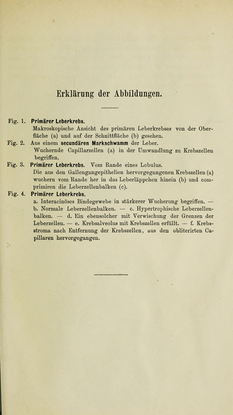 Erklärung der Abbildungen. Fig. 1. Fig. 2. Fig. 3. Fig. 4. Primärer Leberkrebs. Makroskopische Ansicht des primären Leberkrebses von der Ober¬ fläche (a) und auf der Schnittfläche (b) gesehen. Aus einem secundären Markschwamm der Leber. Wuchernde Capillarzellen (a) in der Umwandlung zu Krebszellen begriffen. Primärer Leberkrebs. Vom Rande eines Lobulus. Die aus den Gallengangepithelien hervorgegangenen Krebszellen (a) wuchern vom Rande her in das Leberläppchen hinein (b) und com- primiren die Leberzellenbalken (c). Primärer Leberkrebs. a. Interacinöses Bindegewebe in stärkerer Wucherung begriffen. — b. Normale Leberzellenbalken. — c. Hypertrophische Leberzellen¬ balken. — d. Ein ebensolcher mit Verwischung der Grenzen der Leberzelleu. — e. Krebsalveolus mit Krebszellen erfüllt. — f. Krebs¬ stroma nach Entfernung der Krebszellen, aus den obliterirten Ca- pillaren hervorgegangen.