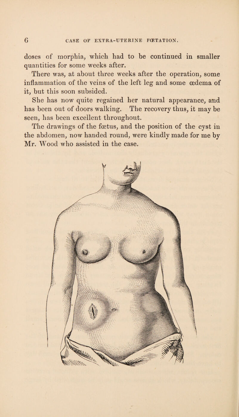 doses of morphia, which had to be continued in smaller quantities for some weeks after. There was, at about three weeks after the operation, some inflammation of the veins of the left leg and some oedema of it, but this soon subsided. She has now quite regained her natural appearance, and has been out of doors walking. The recovery thus, it may be seen, has been excellent throughout. The drawings of the foetus, and the position of the cyst in the abdomen, now handed round, were kindly made for me by Mr. Wood who assisted in the case.