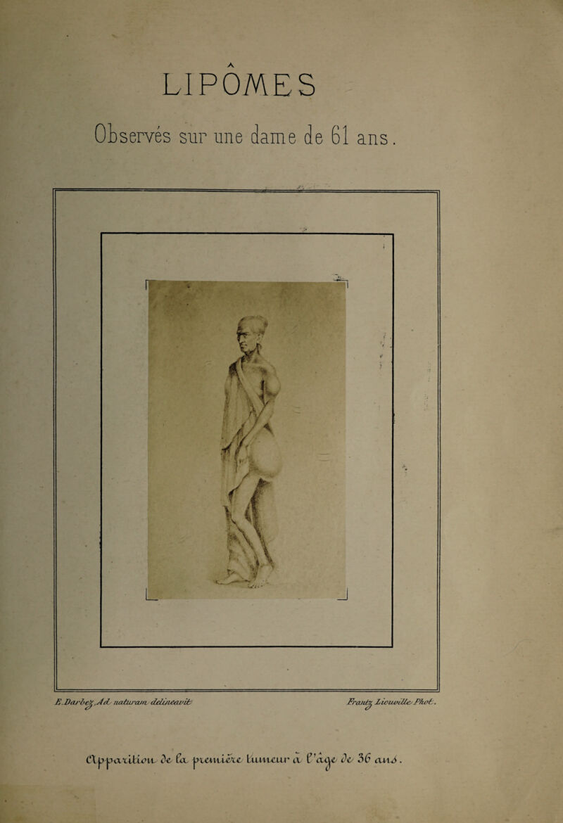 LIPOMES Observés sur une dame de 6é e Di ans E.Da/'be^,A(L naturcu/v deluieavite Franfr^ Z ioavilie/ P/wf, (fl ppatUi chu d-c (dx ptmticxc Lilm/ulllt cl CbxLje do 36 oxlS .
