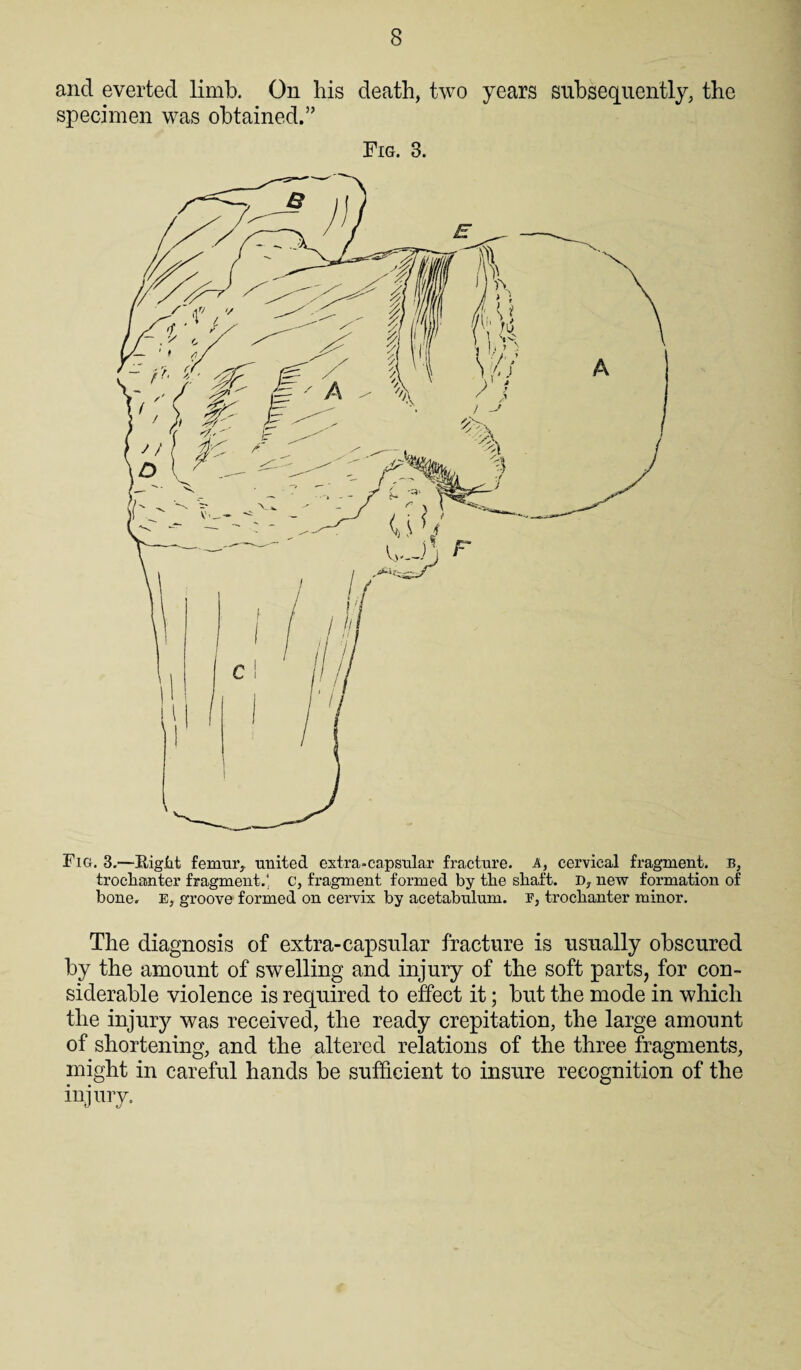 and everted limb. On bis death, two years subsequently, the specimen was obtained.” Fig. 3. Fig. 3.—Right femur, united extra-capsular fracture. A, cervical fragment, b, troclianter fragment.' c, fragment formed by tlie shaft, n, new formation of bone. E, groove formed on cervix by acetabulum, e, troclianter minor. The diagnosis of extra-capsular fracture is usually obscured by the amount of swelling and injury of the soft parts, for con¬ siderable violence is required to effect it; but the mode in which the injury was received, the ready crepitation, the large amount of shortening, and the altered relations of the three fragments, might in careful hands be sufficient to insure recognition of the injury.