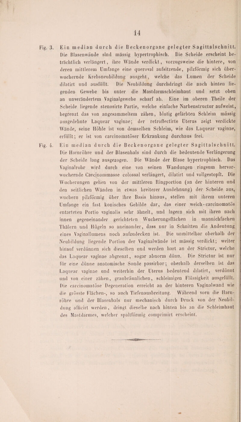 Fig. 3. Ein median durch die Beckenorgane gelegter Sagittalschnitt. Die Blasenwände sind massig hypertrophisch. Die Scheide erscheint be¬ trächtlich verlängert, ihre Wände verdickt, vorzugsweise die hintere, von deren mittlerem Umfange eine queroval aufsitzende, pilzförmig sich über¬ wuchernde Krebsneubildung ausgeht, welche das Lumen der Scheide dilatirt und ausfüllt. Die Neubildung durchdringt die nach hinten lie¬ genden Gewebe bis unter die Mastdarmschleimhaut und setzt oben an unverändertem Vaginalgewebe scharf ab. Eine im oberen Theile der Scheide liegende stenosirte Partie, welche einfache Narbenstructur aufweist, begrenzt das von angesammeltem zähen, blutig gefärbten Schleim massig ausgedehnte Laquear vaginae; der retroflectirte Uterus zeigt verdickte Wände, seine Höhle ist von demselben Schleim, wie das Laquear vaginae, erfüllt; er ist von carcinomatöser Erkrankung durchaus frei. Fig. 4. Ein median durch die Beckenorgane gelegter Sagittalschnitt. Die Harnröhre und der Blasenhals sind durch die bedeutende Verlängerung der Scheide lang ausgezogen. Die Wände der Blase hypertrophisch. Das Vaginalrohr wird durch eine von seinen Wandungen ringsum hervor¬ wuchernde Carcinommasse colossal verlängert, dilatirt und vollgestopft. Die Wucherungen gehen von der mittleren Ringportion (an der hinteren und den seitlichen Wänden in etwas breiterer Ausdehnung) der Scheide aus, wuchern pilzförmig über ihre Basis hinaus, stellen mit ihrem unteren Umfange ein fast konisches Gebilde dar, das einer weich - carcinomatös entarteten Portio vaginalis sehr ähnelt, und lagern sich mit ihren nach innen gegeneinander gerichteten Wucherungsflächen in mannichlachen Thälern und Hügeln so aneinander, dass nur in Schnitten die Andeutung eines Vaginallumens noch aufzudecken ist. Die unmittelbar oberhalb der Neubildung liegende Portion der Vaginal wände ist mässig verdickt; weiter hinauf verdünnen sich dieselben und werden hart an der Strictur, welche das Laquear vaginae abgrenzt, sogar abnorm dünn. Die Strictur ist nur für eine dünne anatomische Sonde passirbar; oberhalb derselben ist das Laquear vaginae und weiterhin der Uterus bedeutend dilatirt, verdünnt und von einer zähen, graubräunlichen, schleimigen Flüssigkeit ausgefüllt. Die carcinomatose Degeneration erreicht an der hinteren Vaginalwand wie die grösste Flächen-, so auch Tiefenausbreitung. Während vorn die Harn¬ röhre und der Blasenhals nur mechanisch durch Druck von der Neubil¬ dung afficirt werden , dringt dieselbe nach hinten bis an die Schleimhaut des Mastdarmes, welcher spaltförmig comprimirt erscheint. —-- —