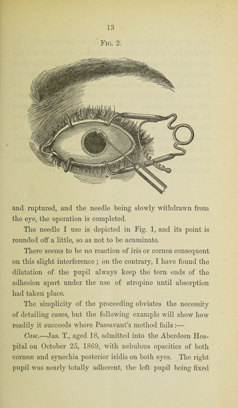 Fig. 2. and ruptured, and the needle being slowly withdrawn from the eye, the operation is completed. The needle I use is depicted in Fig. 1, and its point is rounded off a little, so as not to be acuminate. There seems to be no reaction of iris or cornea consequent on this slight interference ; on the contrary, I have found the dilatation of the pupil always keep the torn ends of the adhesion apart under the use of atropine until absorption had taken place. The simplicity of the proceeding obviates the necessity of detailing cases, but the following example will show how readily it succeeds where Passavant’s method fails :— Case.—Jas. T., aged 18, admitted into the Aberdeen Hos¬ pital on October 25, 1869, with nebulous opacities of both cornese and synechia posterior iridis on both eyes. The right pupil was nearly totally adherent, the left pupil being fixed