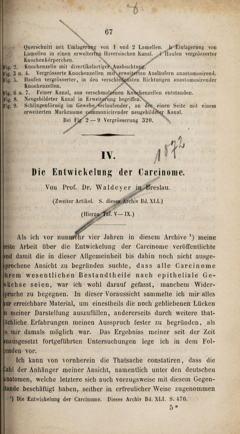 \ Fig. Fig. B-'ig. Fig. Fig. p-'ig* Querschnitt mit Umlageroqg von 1 und 2 Lamellen. Einlagerung von Lamellen in einen erweiterten llaversisclien Kanal, .tf 'liaufen vergrosserter Knochenkörperchen. 2. Knochenzelle mit divertikelartigeE:^usbuchtujjtgr. 3 u. -i. Vergrösserte Knochenzellen init\ervvei|.etten Ausläufern anastornosirend. 5. Haufen vergrosserter, in den verschieH^ten Richtungen anastomosirender Knochenzellen. y/ \ 6 u. 7. Feiner Kanal, aus verschmelzten Knl^^henzellen entstanden. 8. Neiigebildeter Kanal in Ervveitefung begriflen\, 9. Schlingenförinig im Geweb^^rlaufender, an dör, einen Seite mit einem erweiterten Markraurae cmnraunicirender neugebild^ei' Kanal. Bei Figf2 — 9 Vergrösserung 320. lY. Die Entwickelung der Carcinonie. Von Prof. Dr. Waldeyer ift^reslau. (Zweiter Artikel. S. (Hierzi . V— IX.) ßd.XLL) Als ich vor nuninfhr vier Jahren in diesem Archive meine trsle Arbeit über die Entwickelung der Carcinonie veröffentlichte ind damit die in dieser Allgemeinheit bis dahin noch nicht ausge- .prochene Ansicht zu begründen suchte, dass alle Carciiiome hrein wesentlichen Bestandtheile nach epitheliale Ge- vächse seien, war ich wohl darauf gefasst, manchem Wider- pruche zu begegnen. In dieser Voraussicht sammelte ich mir alles lur erreichbare Material, um einestheils die noch gebliebenen Lücken n meiner Darstellung auszufüllen, andererseits durch weitere that- ächliche Erfahrungen meinen Ausspruch fester zu begründen, als s mir damals möglich war. Das Ergebniss meiner seit der Zeit inausgesetzt fortgeführten Untersuchungen lege ich in dem Fei¬ enden vor. Ich kann von vornherein die Thatsache constatiren, dass die iahl der Anhänger meiner Ansicht, namentlich unter den deutschen matomen, welche letztere sich auch vorzugsweise mit diesem Gegen- tande beschäftigt haben, seither in erfreulicher Weise zugenommen D Die Entwickelung der Carcinome, Dieses Archiv ßd. XLL S. 470. 5*