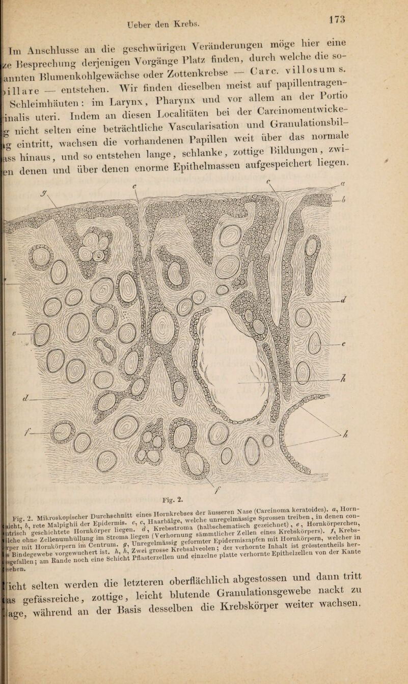I Im Anschlüsse an die geschwungen Veränderungen möge hier eine L Besprechung derjenigen Vorgänge Platz finden, durch welche die sc¬ annten Blumenkohlgewächse oder Zottenkrebse — Care, villosums. [illare — entstehen. Wir finden dieselben meist aut papillentragen- ; Schleimhäuten: im Larynx, Pharynx und vor allem an der 1 01 10 inalis uteri. Indem an diesen Localitäten hei der Carcinomeiitw.cke- U nicht selten eine beträchtliche Vascularisation und Granulations i l eintritt, wachsen die vorhandenen Papillen weit über das normale iss hinaus, und so entstehen lange, schlanke, zottige Bildungen zwi¬ rn denen und über denen enorme Epithelmassen aufgespeichert heg . Fig. 2. . • tt .„i.v„v,Coi- riov äusseren Nase (Carcinoma keratoides). ö, Hoin- ?ig. 2. Mikroskopischer Durchschnitt eines 01 welche unregelmässige Sprossen treiben, in denen con- it, 6, rete Malpighii der Epidermis, c, c (halbschematisch gezeichnet) , e, Hornkörperchen, isch geschichtete Hornkorper liegen. <*, (^reer^0Srtnuno. sämmtlicher Zellen eines Krebskörpers). /, Ivrebs- le ohne Zellenumhüllung im Stroma liegenl (^ f°ormter Epidermis zapfen mit Hornkörpern, welcher in sr mit Hornkörpern im Centruin, g, Unregel ^regbgalveolen / der verhornte Inhalt ist grösstentheils her- sfallen^^m^^^de^oc^eine Schicht Pflasterzellen und einzelne platte verhornte Epithelzellen von der Kante len. ht selten werden die letzteren oberflächlich abgestossen und dann tritt ' „efäsSreiche zottige, leicht blutende Granulationsgewebe nackt zu J während an der Basis desselben die Krebskörper weiter wachsen.
