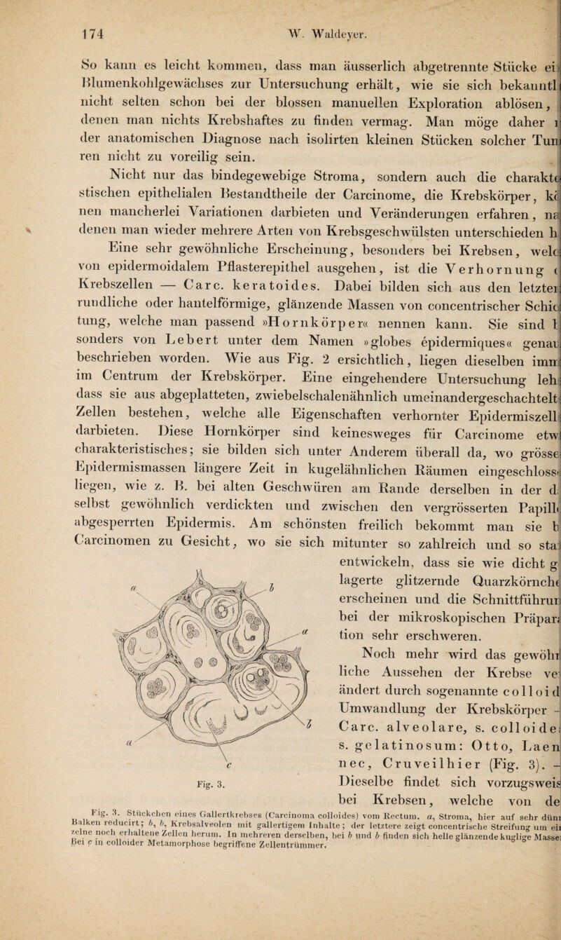 So kann es leicht kommen, dass man äusserlich abgetrennte Stücke ei Blumenkohlgewächses zur Untersuchung erhält, wie sie sich bekanntlj nicht selten schon bei der blossen manuellen Exploration ablösen, denen man nichts Krebshaftes zu finden vermag. Man möge daher i der anatomischen Diagnose nach isolirten kleinen Stücken solcher Tum ren nicht zu voreilig sein. j Nicht nur das bindegewebige Stroma, sondern auch die charakto stischen epithelialen Bestandteile der Carcinome, die Krebskörper, k(Q nen mancherlei Variationen darbieten und Veränderungen erfahren, naj denen man wieder mehrere Arten von Krebsgeschwülsten unterschieden h Eine sehr gewöhnliche Erscheinung, besonders bei Krebsen, weit: von epidermoidalem Pflasterepithel ausgehen, ist die Verhornung cj Krebszellen Care, keratoides. Dabei bilden sich aus den letzter] rundliche oder hantelförmige, glänzende Massen von concentrischer Schic] tung, welche man passend »Hornkörper« nennen kann. Sie sind 1 sonders von Lebert unter dem Namen »globes epidermiques« genau beschrieben worden. Wie aus Fig. 2 ersichtlich, liegen dieselben imrr: im Centrum der Krebskörper. Eine eingehendere Untersuchung leh dass sie aus abgeplatteten, zwiebelschalenähnlich umeinandergeschachtelt: Zellen bestehen, welche alle Eigenschaften verhornter Epidermiszell: darbieten. Diese Hornkörper sind keinesweges für Carcinome etwl charakteiistisches; sie bilden sich unter Anderem überall da, wo grosse; Epidermismassen längere Zeit in kugelähnlichen Räumen eingeschlossc liegen, wie z. B. bei alten Geschwüren am Rande derselben in der d; selbst gewöhnlich verdickten und zwischen den vergrösserten Papill abgespeirten Epidermis. Am schönsten freilich bekommt man sie 1 Carcinomen zu Gesicht, wo sie sich mitunter so zahlreich und so sta entwickeln, dass sie wie dicht g lagerte glitzernde Quarzkörnch erscheinen und die Schnittführui bei der mikroskopischen Präpar tion sehr erschweren. Noch mehr wird das gewöh liehe Aussehen der Krebse ve ändert durch sogenannte c o 11 o i c Umwandlung der Krebskörper - Care, alveolare, s. colloide s. gelatinosum: Otto, Laer nec, Cruveilhier (Fig. 3). - Fig. 3. Dieselbe findet sich vorzugswei bei Krebsen, welche von d< Fig. 3. Stückchen eines Gallertkrebses (Carcinoma colloides) vom Rectum, a, Stroma, hier auf sehr dür Balken reducirt; ä, Krebsalveolen mit gallertigem Inhalte; der letztere zeigt concentrische Streifung um e ze ne noch erhaltene Zellen herum. In mehreren derselben, bei b und b finden sich helle glänzende kuglige Massi Bei c in colloider Metamorphose begriffene ZeUentrümmer,