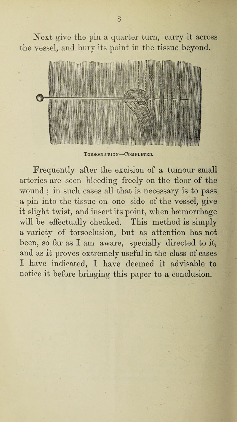 Next give the pin a quarter turn, carry it across the vessel, and bury its point in the tissue beyond. Torsoclusion—Completed. Frequently after the excision of a tumour small arteries are seen bleeding freely on the floor of the wound ; in such cases all that is necessary is to pass a pin into the tissue on one side of the vessel, give it slight twist, and insert its point, when haemorrhage will be effectually checked. This method is simply a variety of torsoclusion, but as attention has not been, so far as I am aware, specially directed to it, and as it proves extremely useful in the class of cases I have indicated, I have deemed it advisable to notice it before bringing this paper to a conclusion.