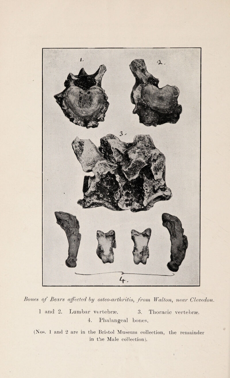 Bones of Becirs affected by osteo-cirthritis, from Wallon, near Clevedon. 1 and 2. Lurabar vert.ebræ. 3. Thoracic vertebræ. 4. Phalangeal bones. (Nos. 1 and 2 are in the Bristol Muséum collection, tlie remainder in the Male collection). 1