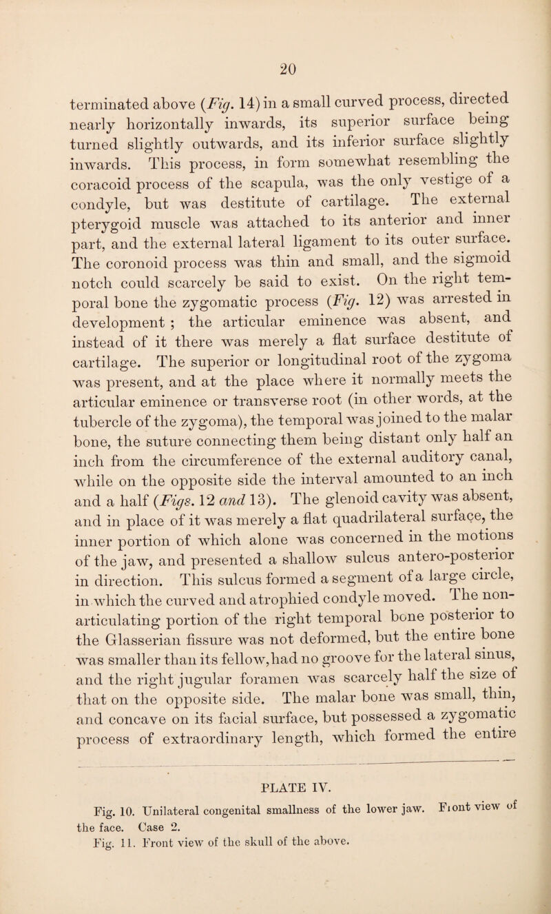 terminated above i^Fig. 14) in a small curved process, directed nearly horizontally inwards, its superior surface being turned slightly outwards, and its inferior surface slightly inwards. This process, in form somewhat resembling the coracoid process of the scapula, was the only vestige of a condyle, but was destitute of cartilage. The external pterygoid muscle was attached to its anterior and inner part, and the external lateral ligament to its outer surface. The coronoid process was thin and small, and the sigmoid notch could scarcely be said to exist. On the right tem¬ poral bone the zygomatic process {Fig. 12) was arrested in development ; the articular eminence was absent, and instead of it there was merely a flat surface destitute of cartilage. The superior or longitudinal root of the zygoma was present, and at the place where it normally meets the articular eminence or transverse root (in other words, at the tubercle of the zygoma), the temporal was joined to the malar bone, the suture connecting them being distant only half an inch from the circumference of the external auditory canal, wdiile on the opposite side the interval amounted to an inch and a half {Figs. 12 and 13). The glenoid cavity was absent, and in place of it was merely a flat quadrilateral surface, the inner portion of which alone w^as concerned in the motions of the jaw, and presented a shallow sulcus antero-posterior in direction. This sulcus formed a segment of a large ciicle, in which the curved and atrophied condyle moved. T he non¬ articulating portion of the right temporal bone posteiior to the Glasserian fissure was not deformed, but the entire bone was smaller than its fellow,had no groove for the lateral sinus, and the right jugular foramen was scarcely half the size of that on the opposite side. The malar bone was small, thin, and concave on its facial surface, but possessed a zygomatic process of extraordinary length, which formed the entiie PLATE IV. Fig. 10. Unilateral congenital smallness of the lower jaw. the face. Case 2. FiL^ 11. Front view of the skull of the above. Fiont view of