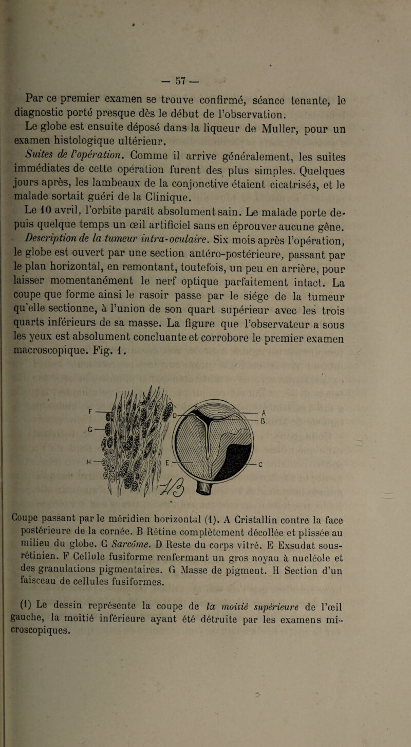 Par ce premier examen se trouve confirmé, séance tenante, le diagnostic porté presque dès le début de l’observation. Le globe est ensuite déposé dans la liqueur de Muller, pour un examen histologique ultérieur. Suites de /’opération. Gomme il arrive généralement, les suites immédiates de cette opération furent des plus simples. Quelques jours après, les lambeaux de la conjonctive étaient cicatrisés, et le malade sortait guéri de la Clinique. Le 10 avril, 1 orbite paraît absolument sain. Le malade porte de¬ puis quelque temps un œil artificiel sans en éprouver aucune gêne. Description de la tumeur intra-oculaire. Six mois après l’opération, le globe est ouvert par une section antéro-postérieure, passant par le plan horizontal, en remontant, toutefois, un peu en arrière, pour laisser momentanément le nerl optique parfaitement intact. La coupe que forme ainsi le rasoir passe par le siège de la tumeur qu elle sectionne, à l’union de son quart supérieur avec les trois quarts inférieurs de sa masse. La figure que l’observateur a sous les yeux est absolument concluante et corrobore le premier examen macroscopique. Fig. 1. Coupe passant par le méridien horizontal (1). A Cristallin contre la face postérieure de la cornée. B Rétine complètement décollée et plissée au milieu du globe. G Sarcome. D Reste du corps vitré. E Exsudât sous- rétinien. F Cellule fusiforme renfermant un gros noyau à nucléole et des granulations pigmentaires. G Masse de pigment. H Section d’un faisceau de cellules fusiformes. (1) Le dessin représente la coupe de la moitié supérieure de l’œil gauche, la moitié inférieure ayant été détruite par les examens mi¬ croscopiques.